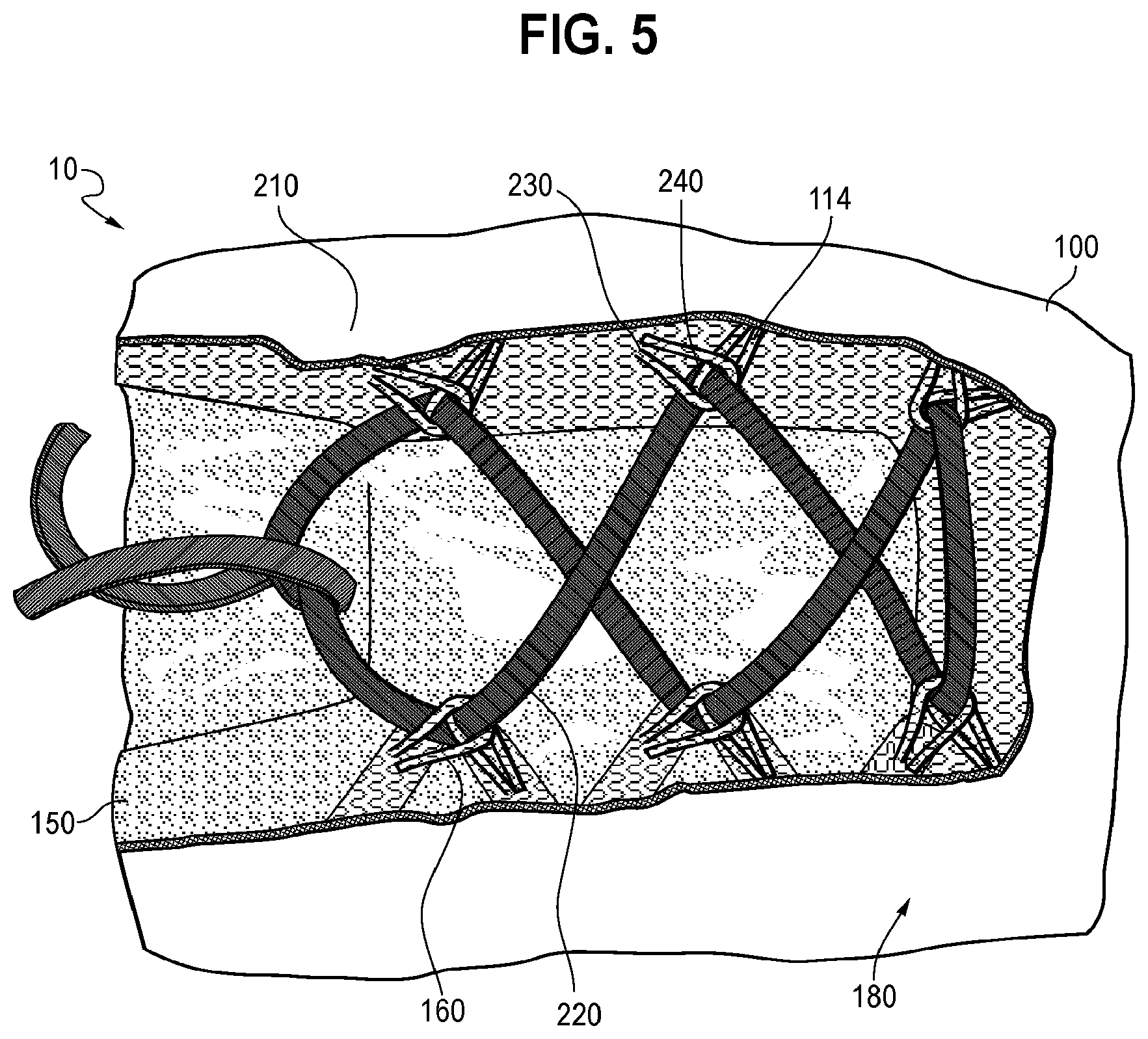 Patent US12324484 Figure 5 – Upper for an article of footwear having an inner component and a shroud
