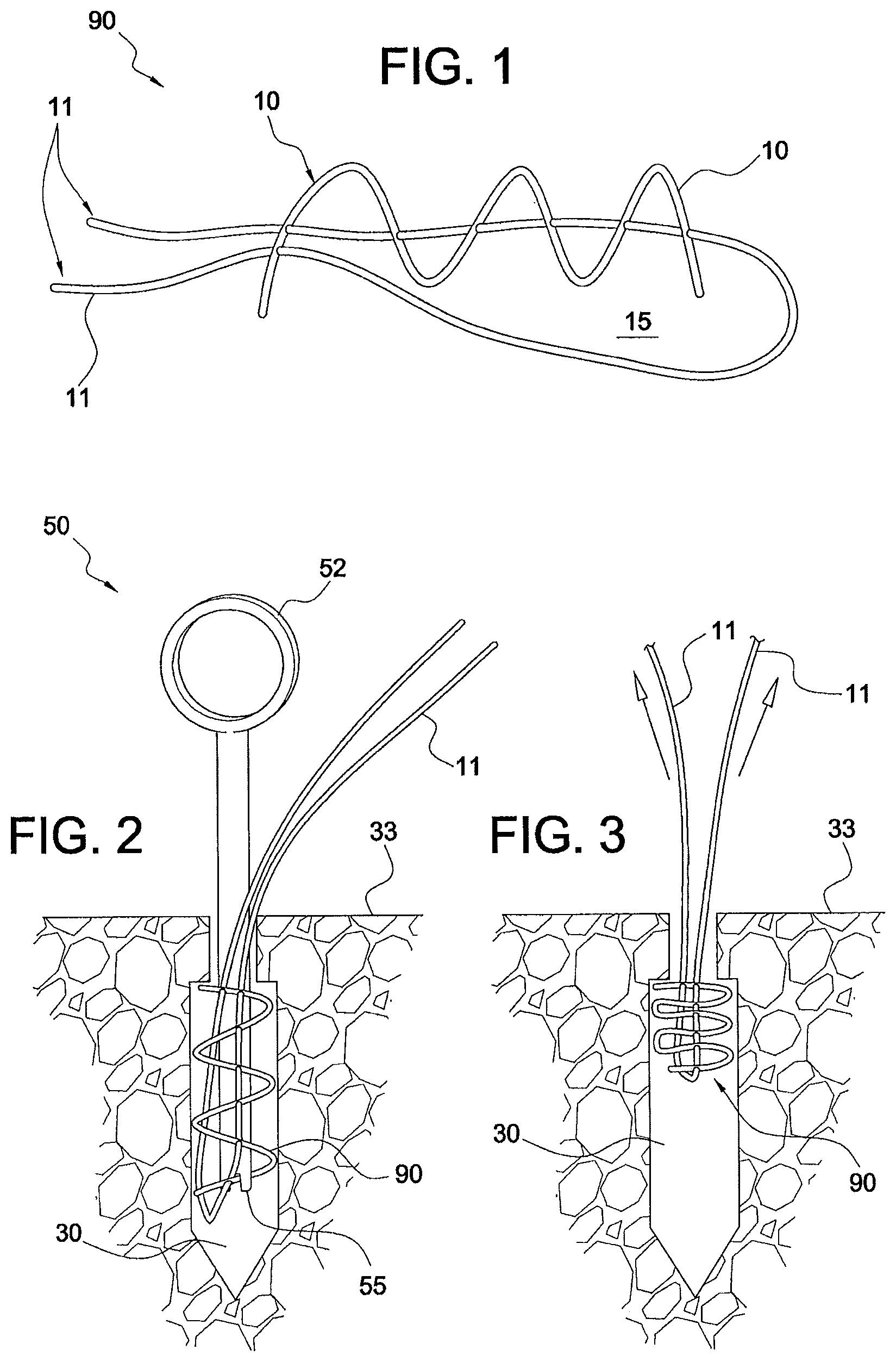 Patent US12324573 Figure 1 – Soft suture-based anchors