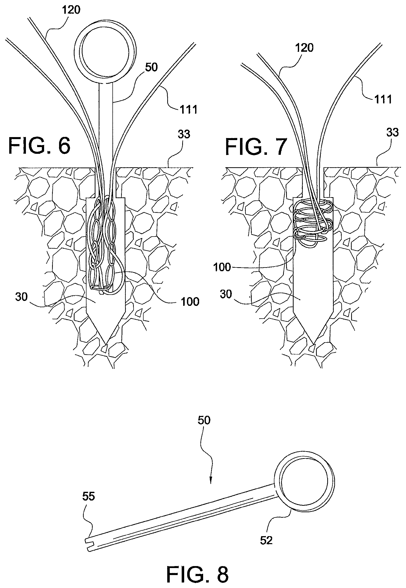 Patent US12324573 Figure 3 – Soft suture-based anchors