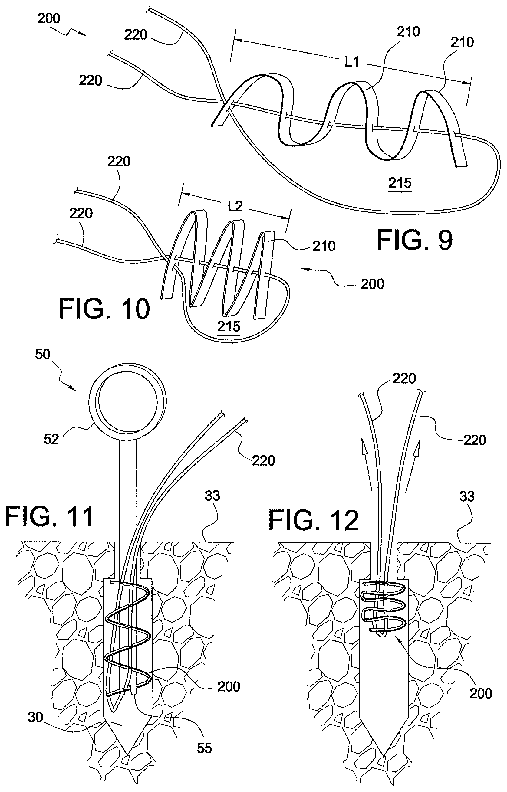 Patent US12324573 Figure 4 – Soft suture-based anchors