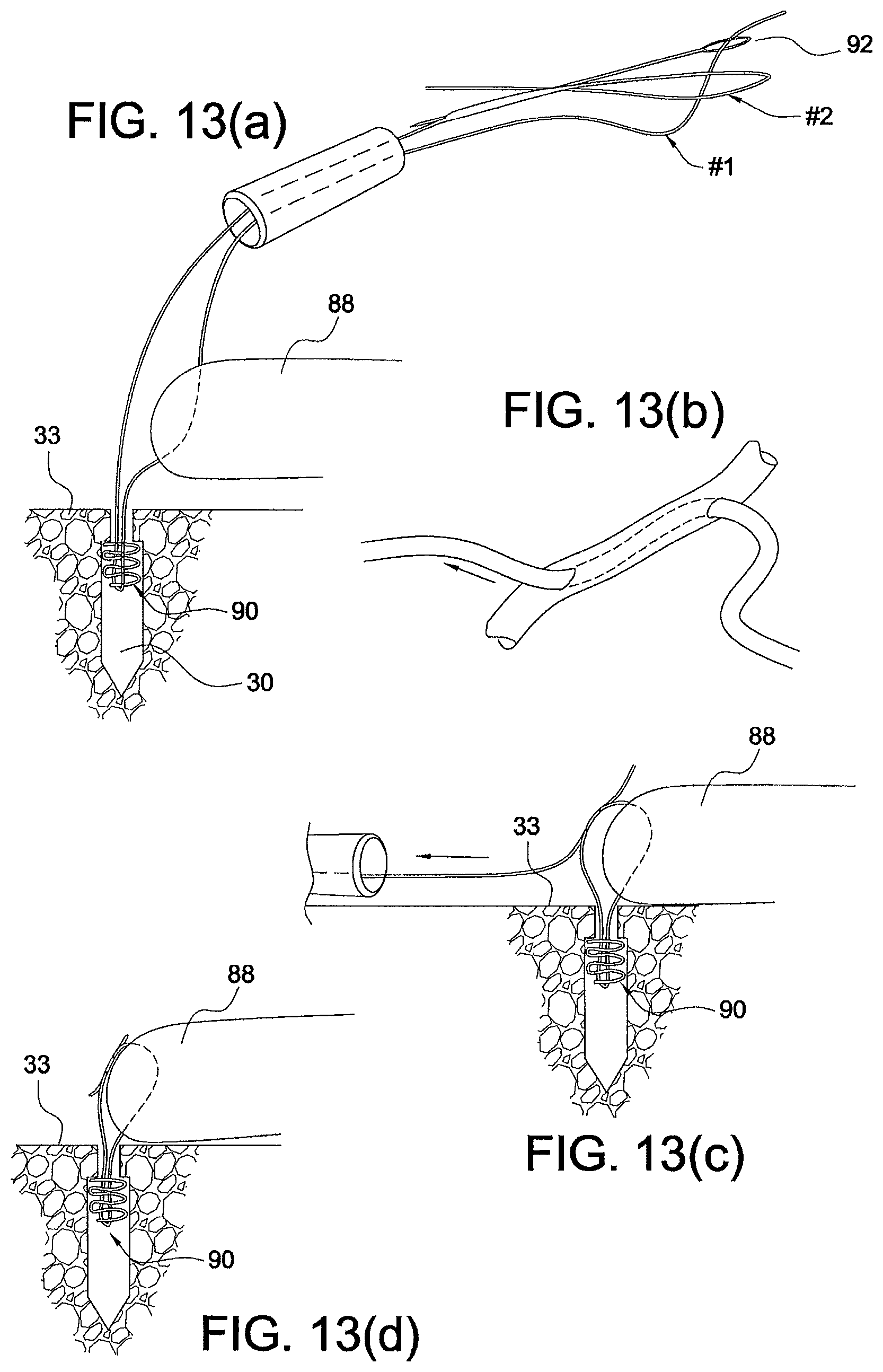 Patent US12324573 Figure 5 – Soft suture-based anchors