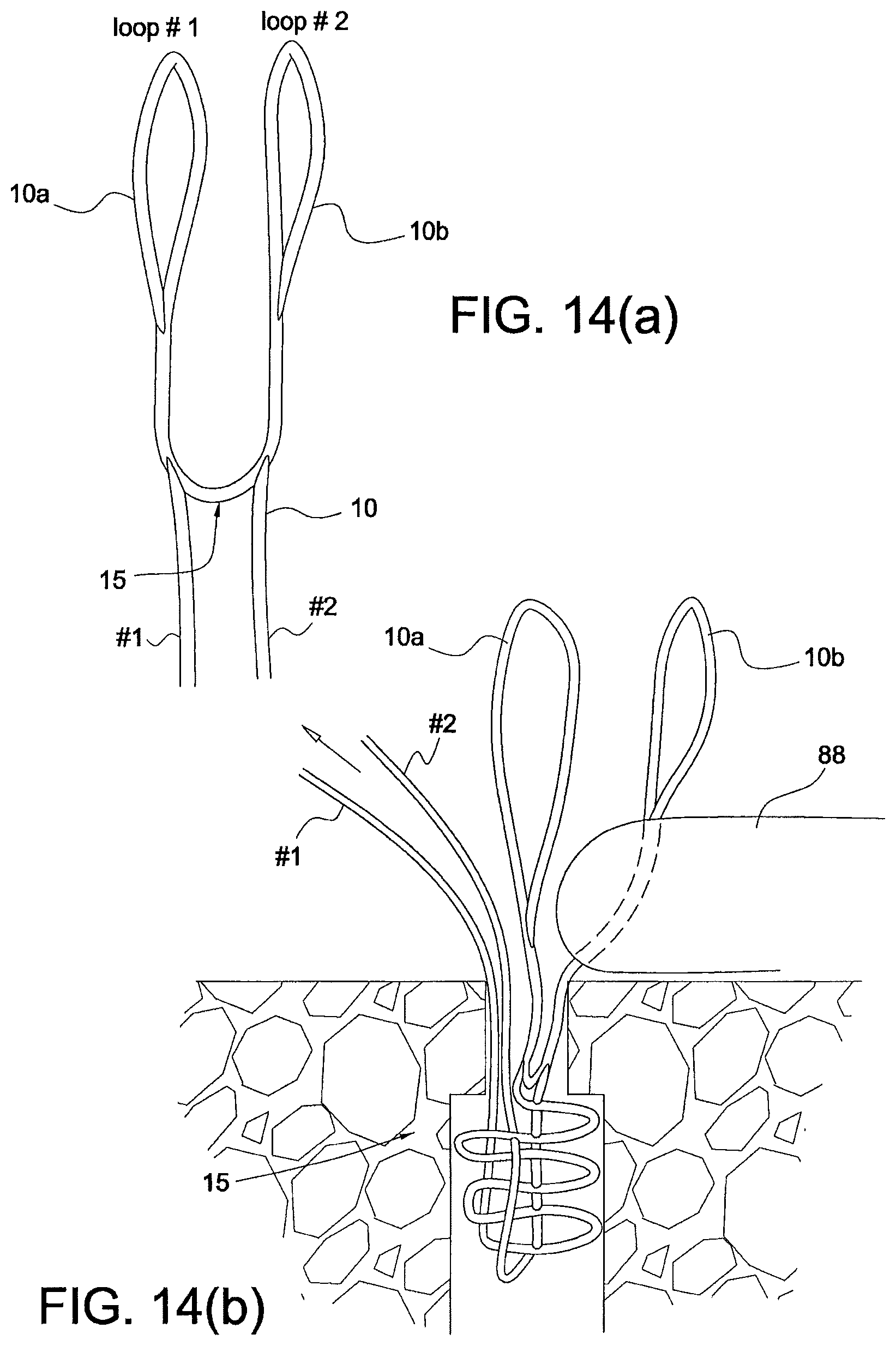 Patent US12324573 Figure 6 – Soft suture-based anchors