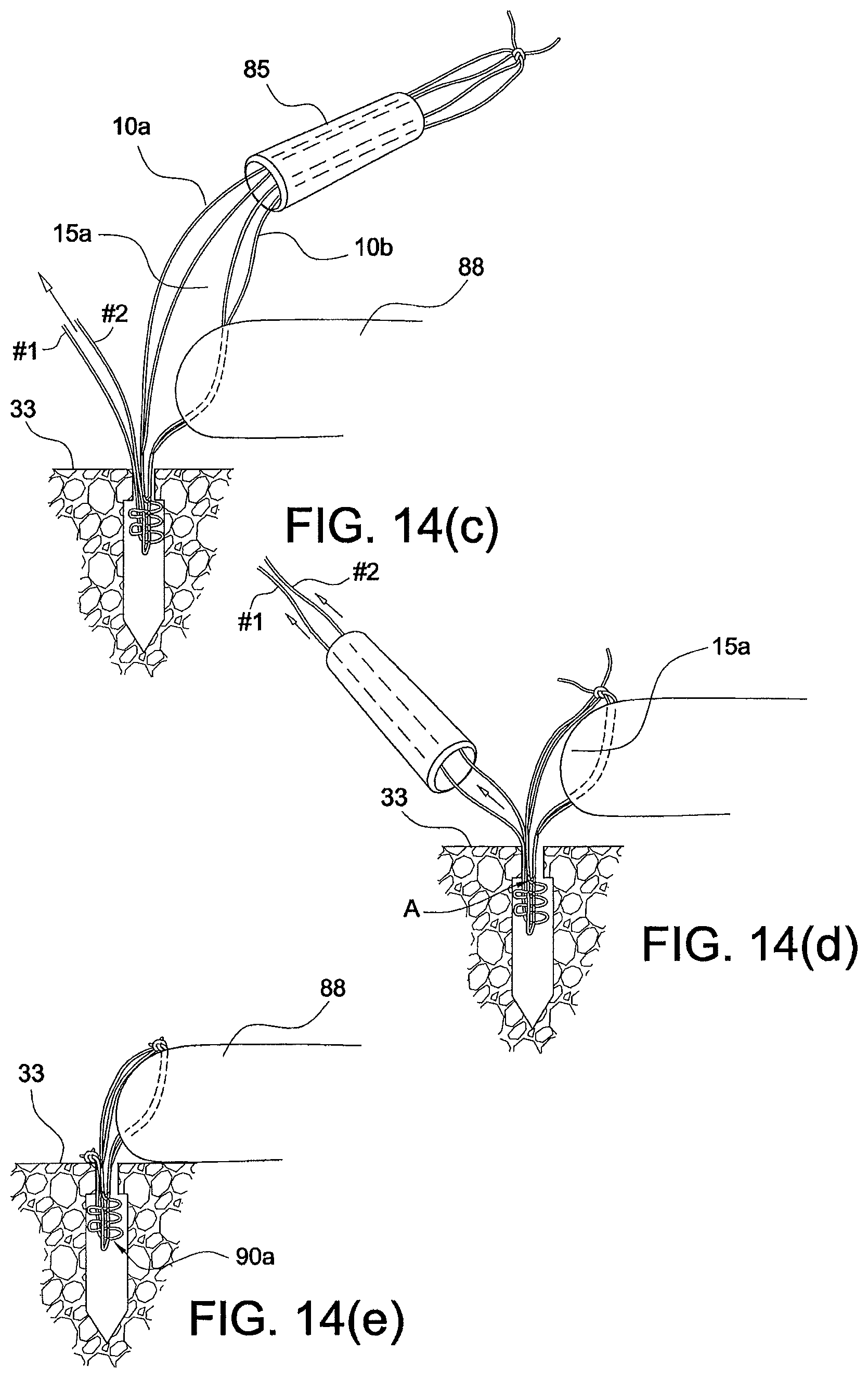 Patent US12324573 Figure 7 – Soft suture-based anchors
