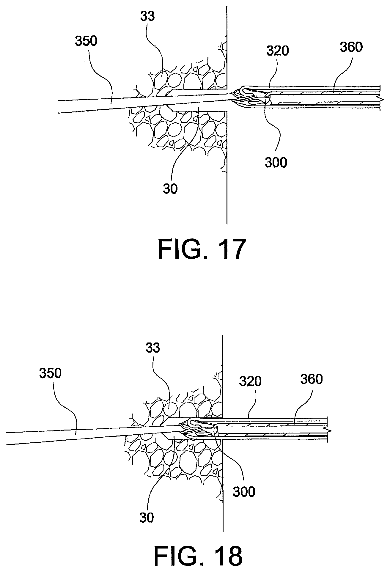 Patent US12324573 Figure 9 – Soft suture-based anchors