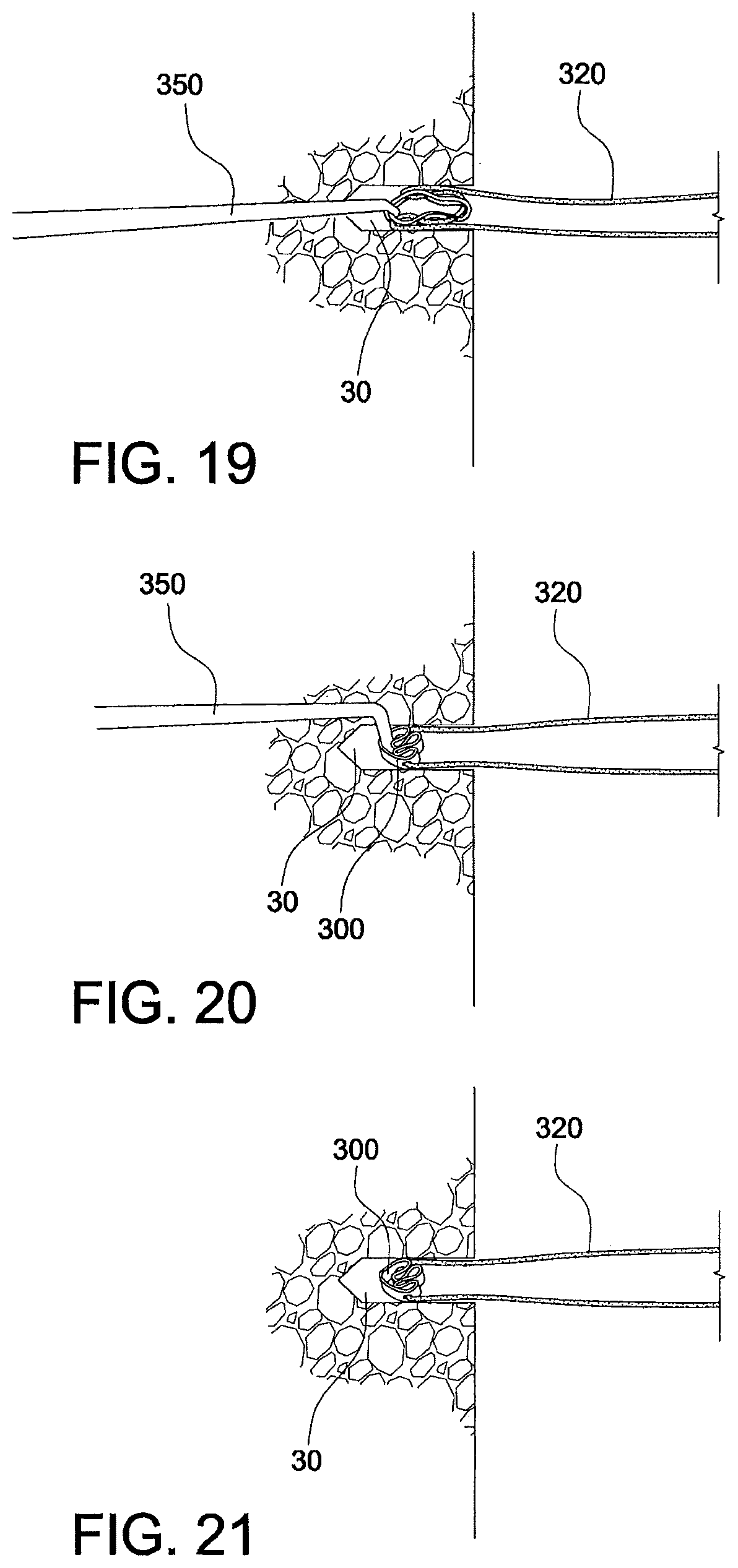 Patent US12324573 Figure 10 – Soft suture-based anchors