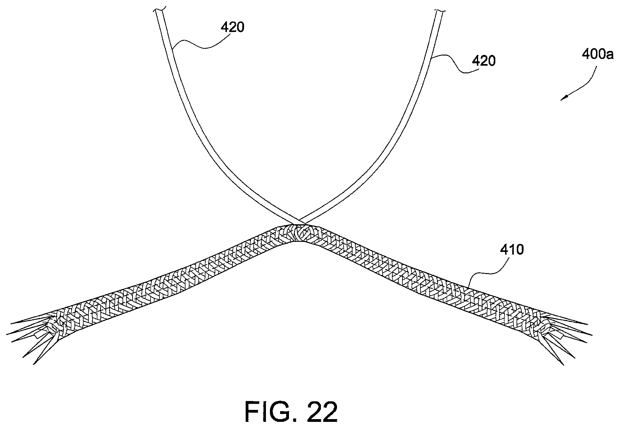Patent US12324573 Figure 11 – Soft suture-based anchors