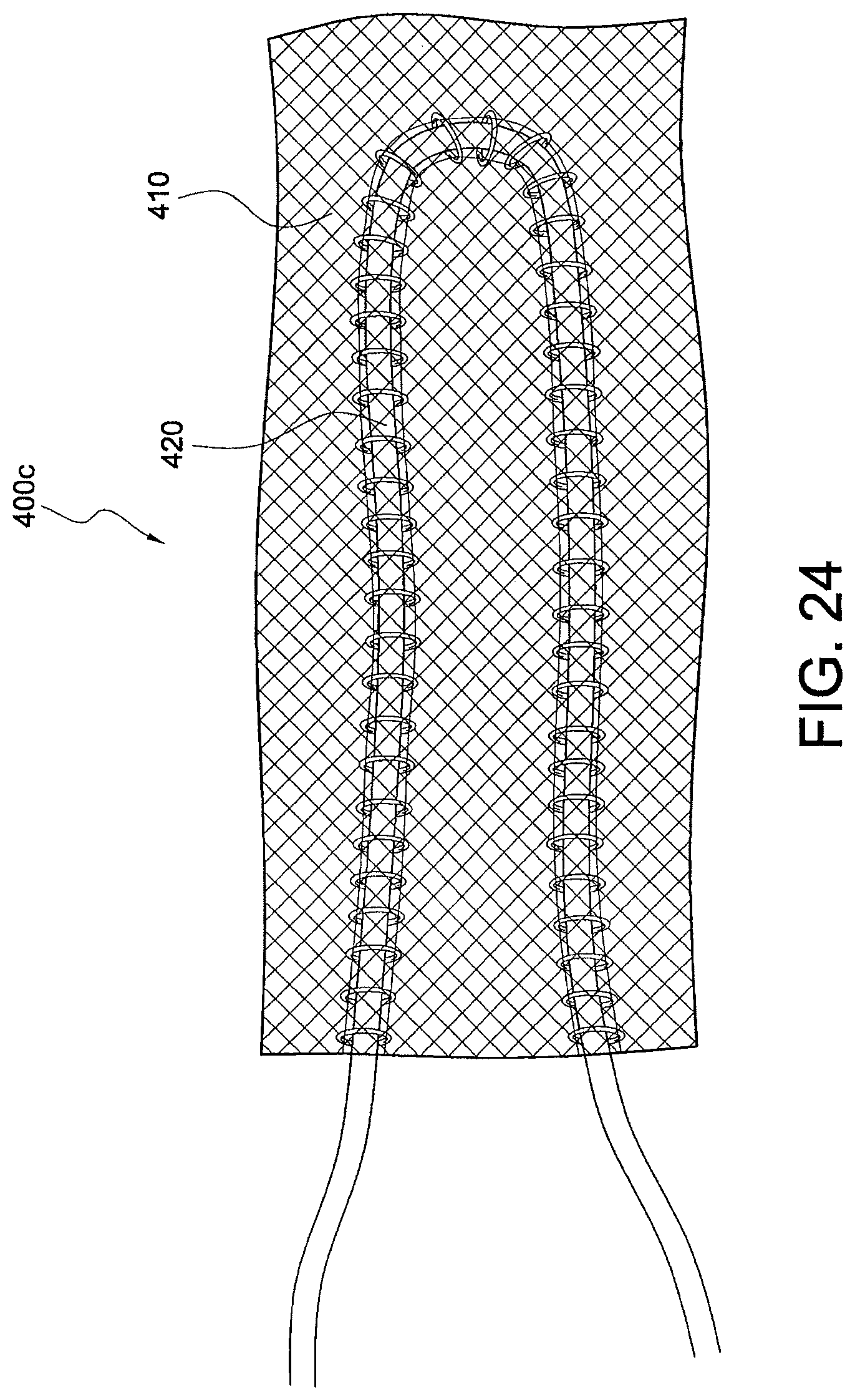 Patent US12324573 Figure 13 – Soft suture-based anchors