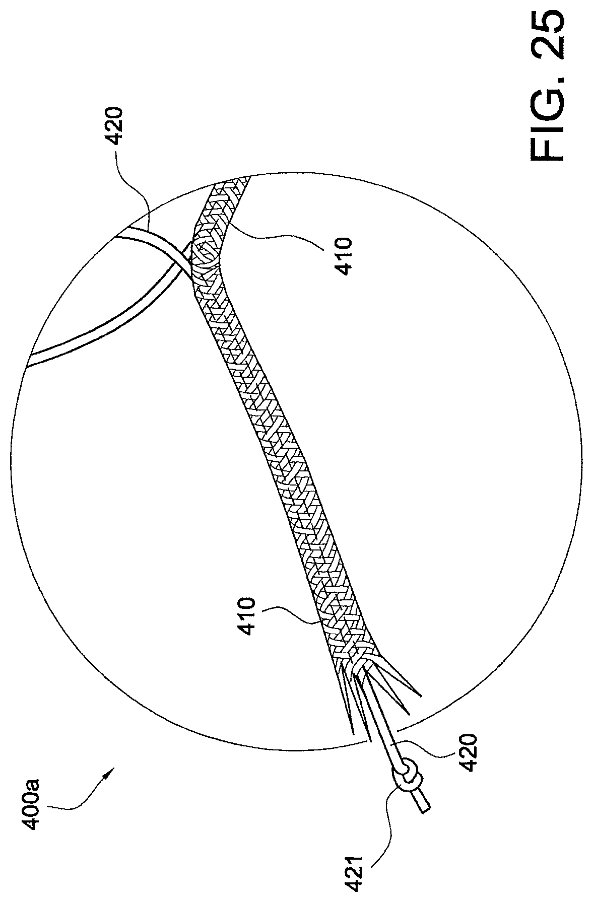 Patent US12324573 Figure 14 – Soft suture-based anchors
