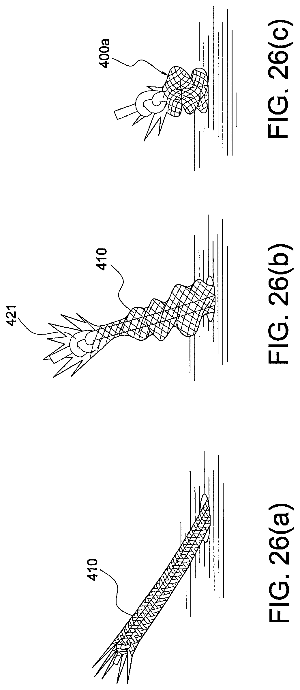 Patent US12324573 Figure 15 – Soft suture-based anchors