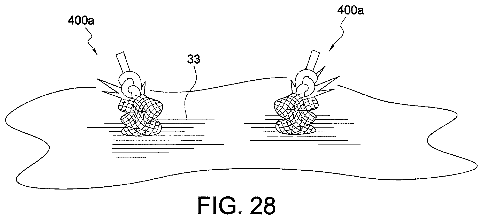 Patent US12324573 Figure 17 – Soft suture-based anchors