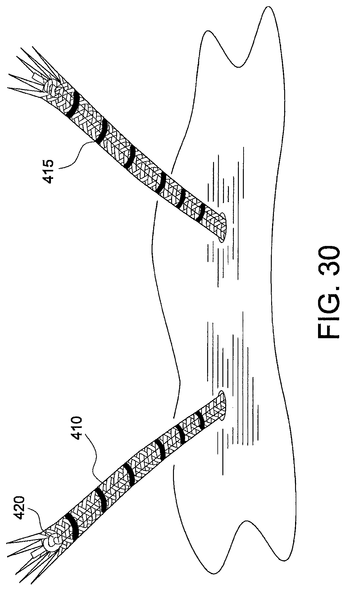 Patent US12324573 Figure 19 – Soft suture-based anchors