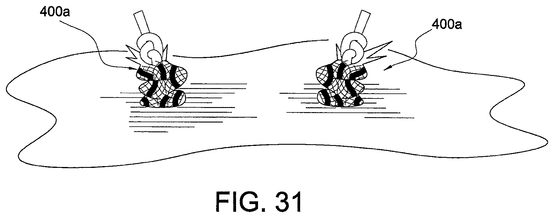 Patent US12324573 Figure 20 – Soft suture-based anchors