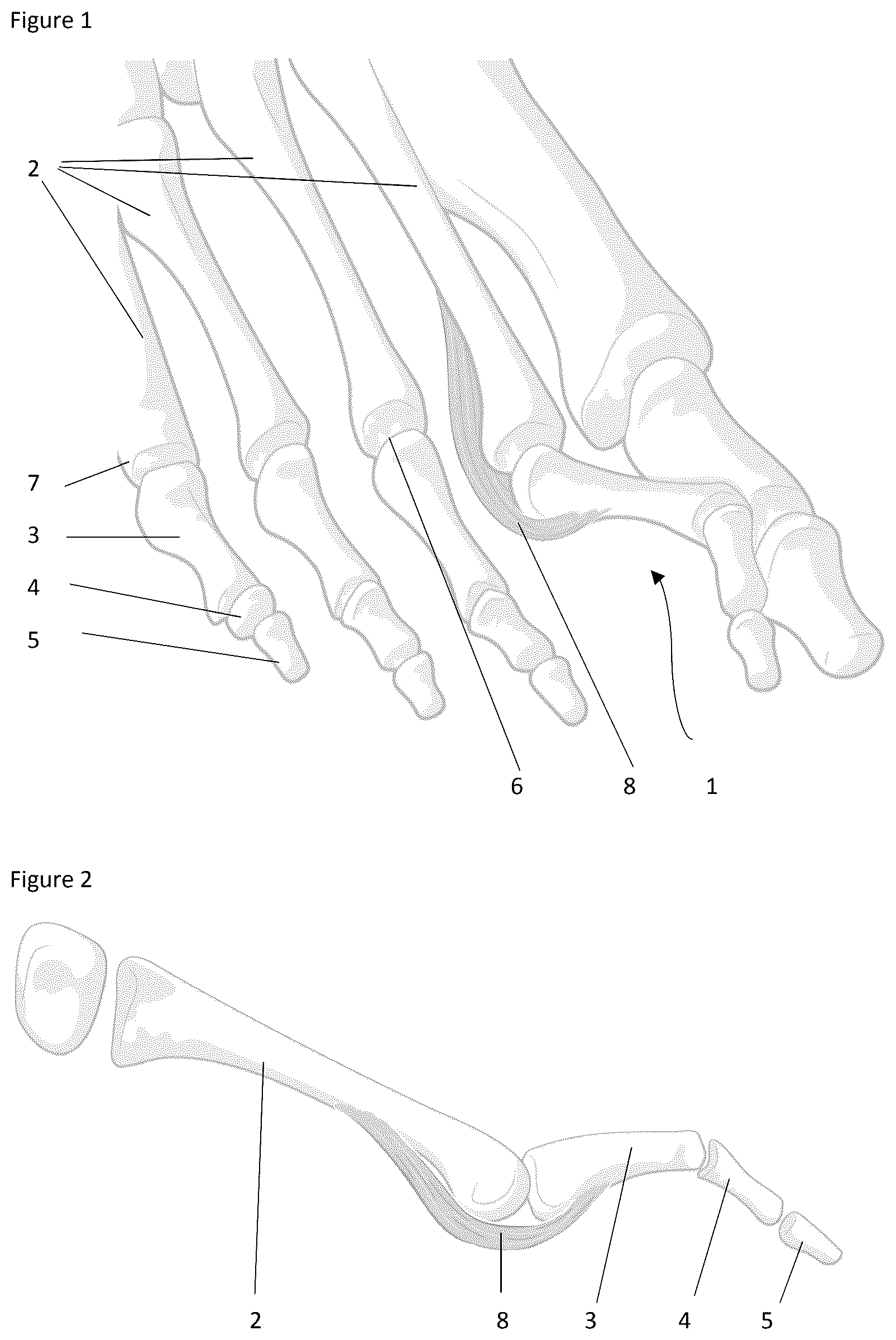 Patent US12324574 Figure 1 – Surgical methods for the treatment of plantar plate injury