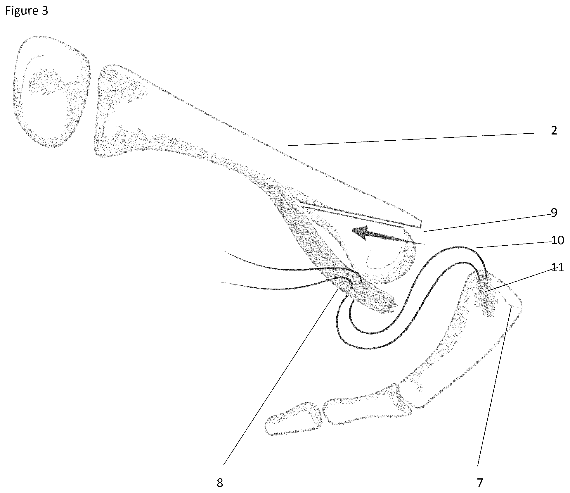 Patent US12324574 Figure 2 – Surgical methods for the treatment of plantar plate injury