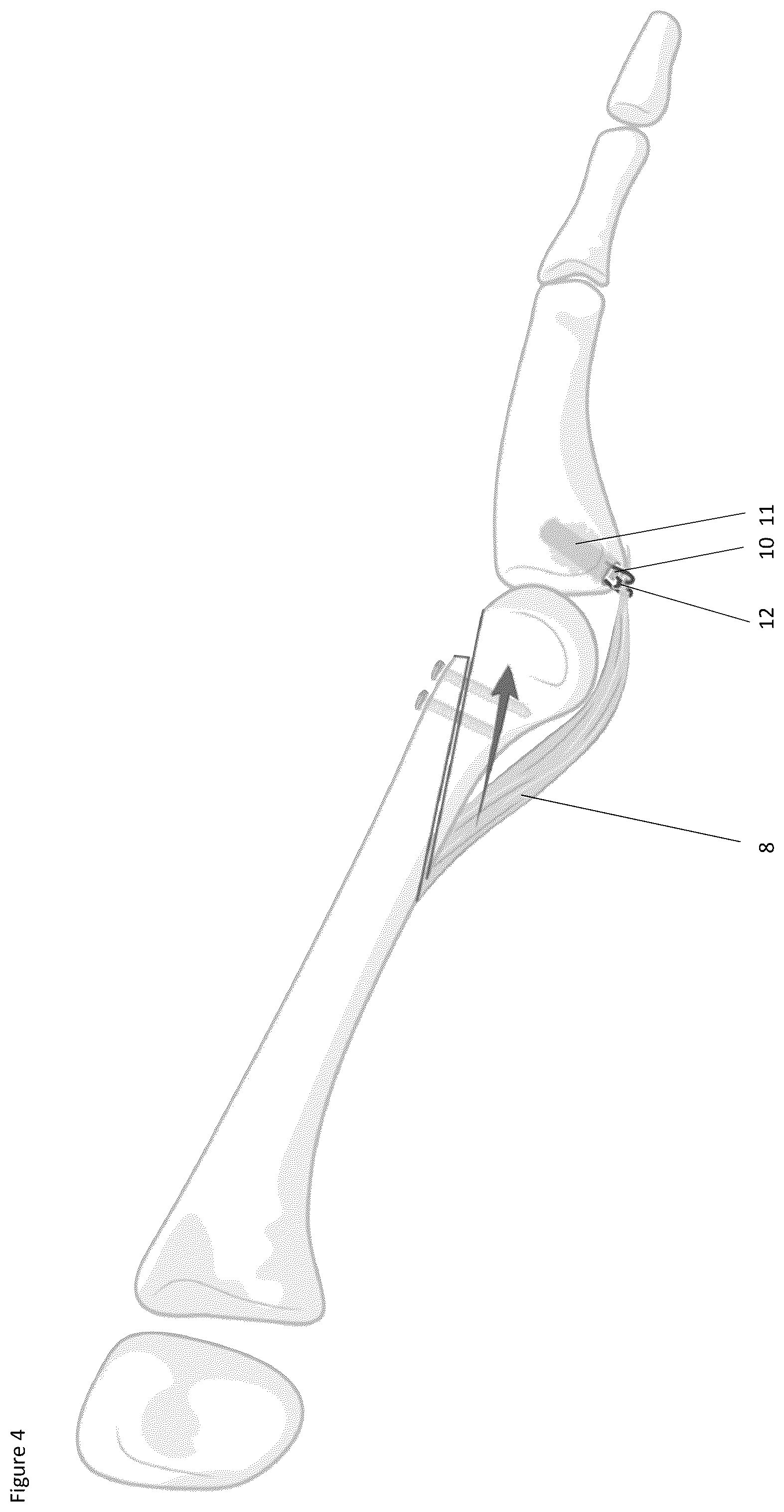 Patent US12324574 Figure 3 – Surgical methods for the treatment of plantar plate injury
