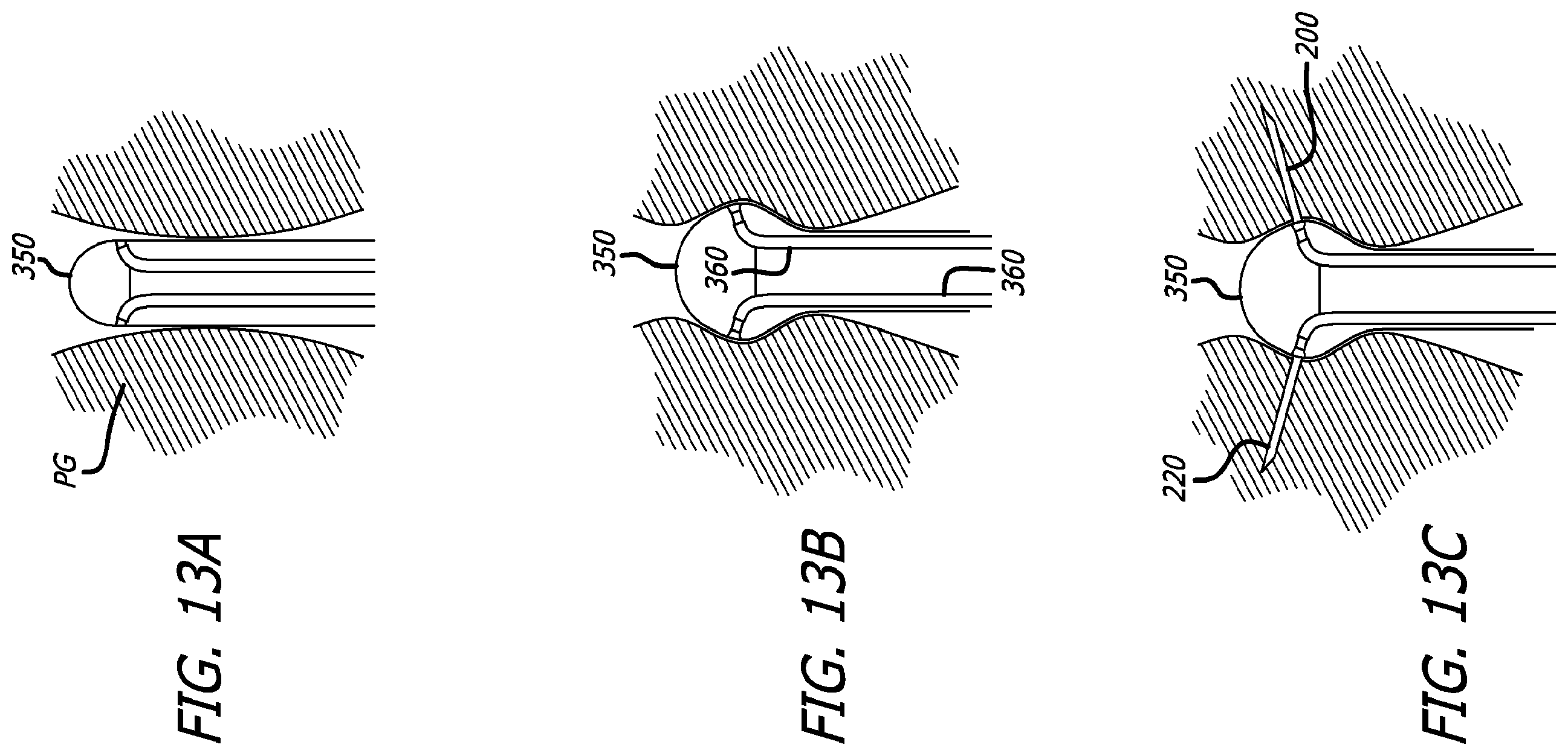 Patent US12324576 Figure 14 – Flexible system for delivering an anchor