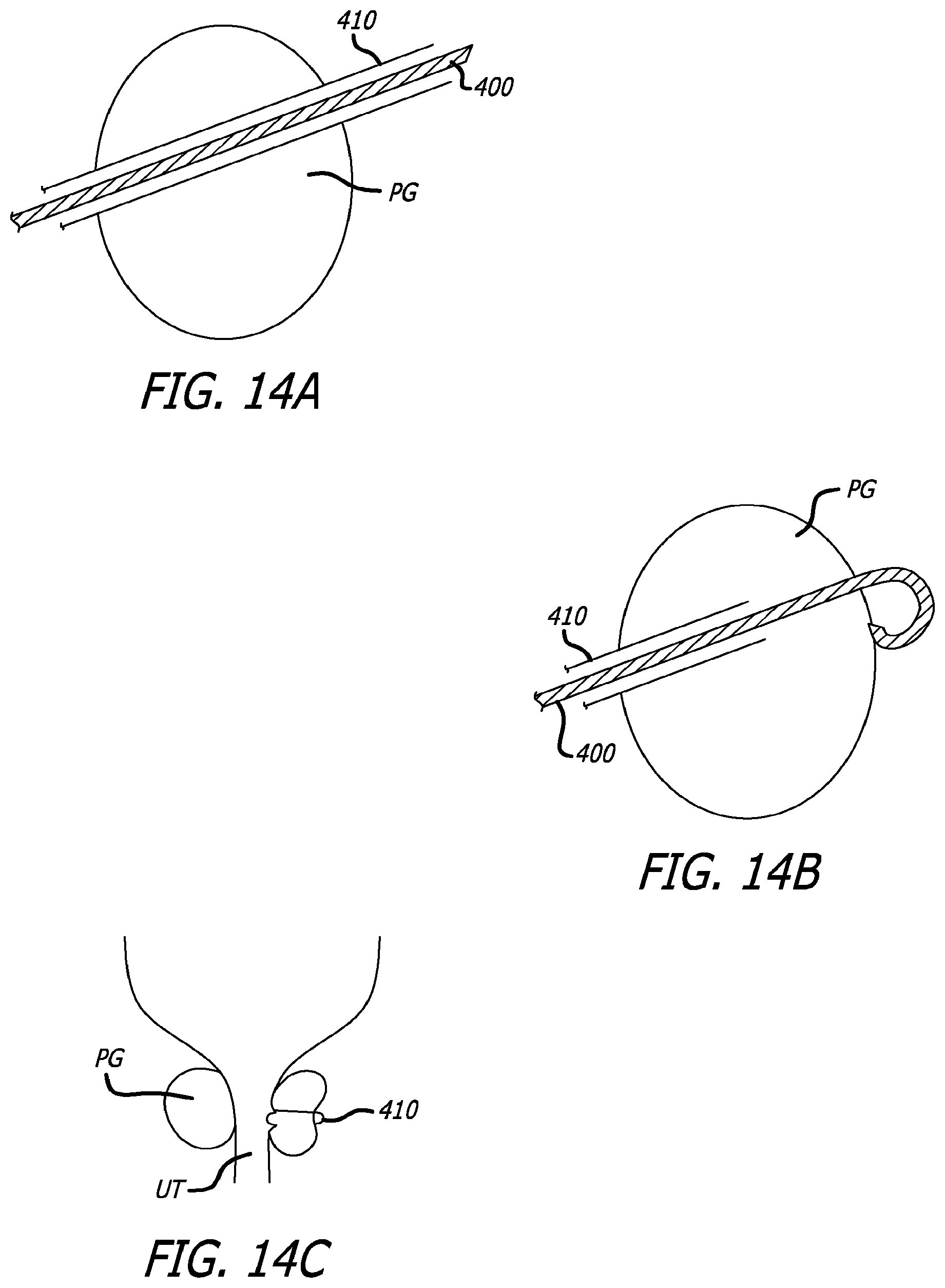 Patent US12324576 Figure 15 – Flexible system for delivering an anchor