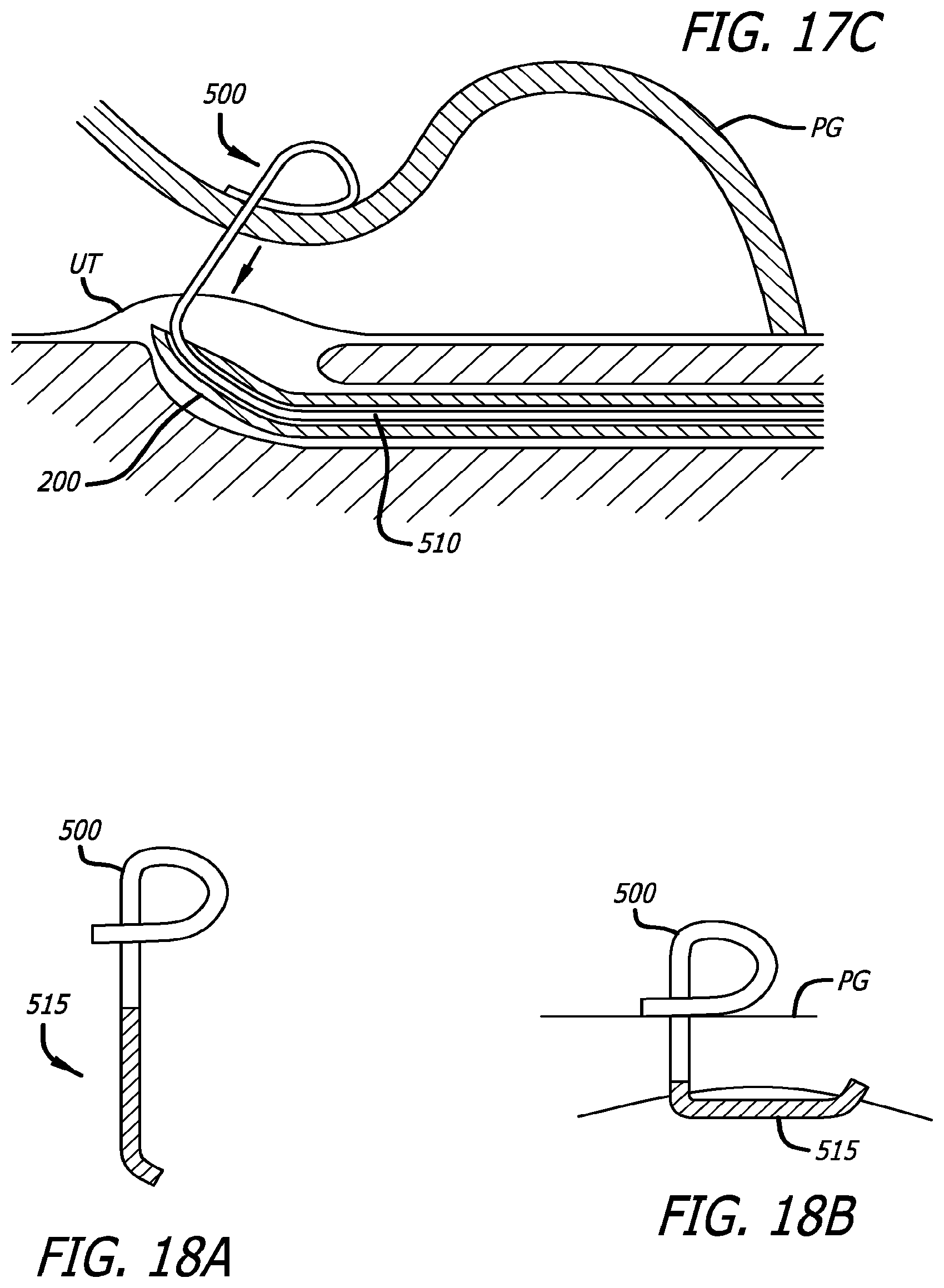 Patent US12324576 Figure 19 – Flexible system for delivering an anchor