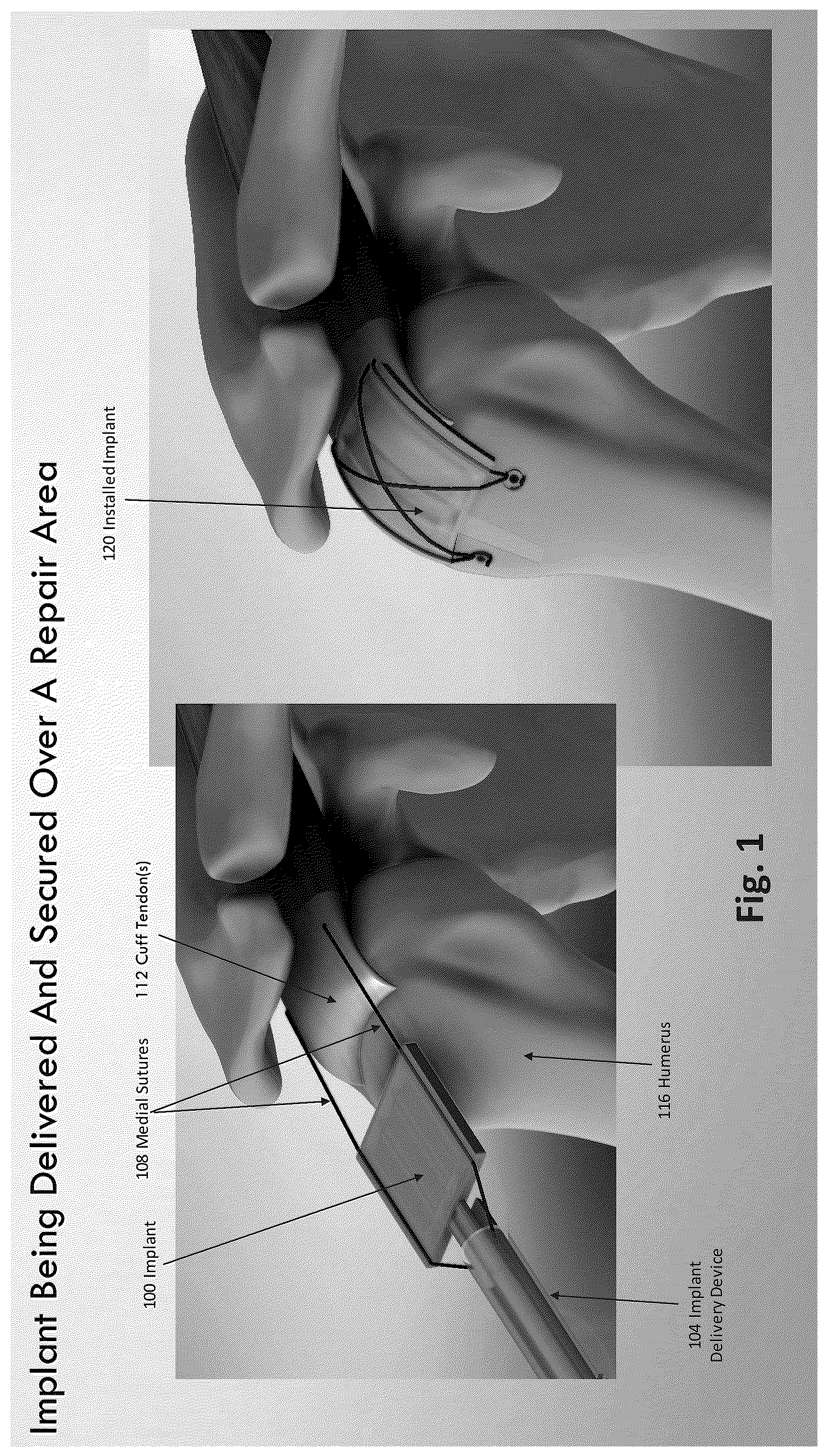 Patent US12324577 Figure 1 – Method of augmenting tissue
