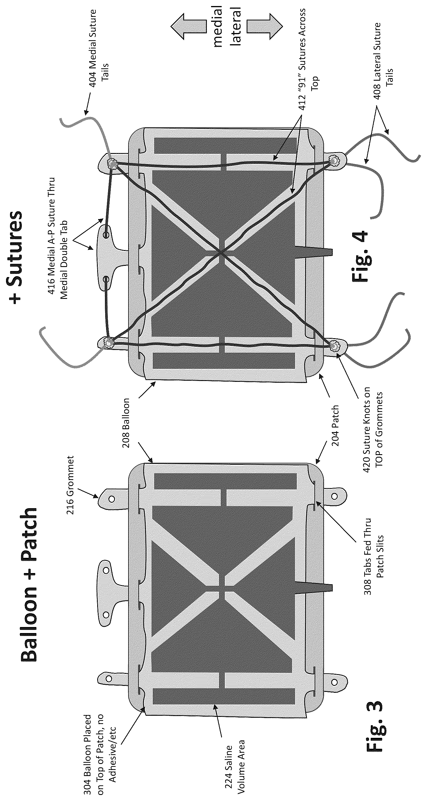 Patent US12324577 Figure 3 – Method of augmenting tissue