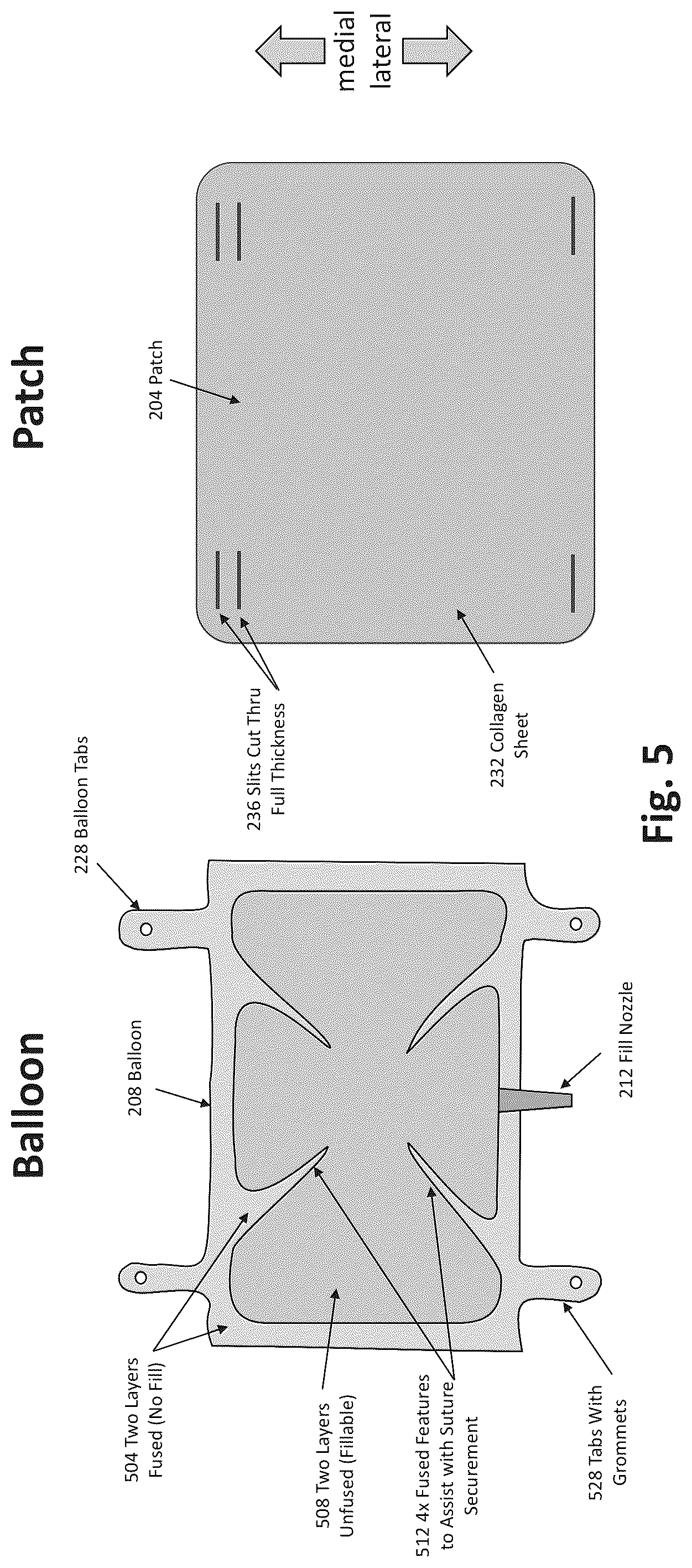 Patent US12324577 Figure 4 – Method of augmenting tissue