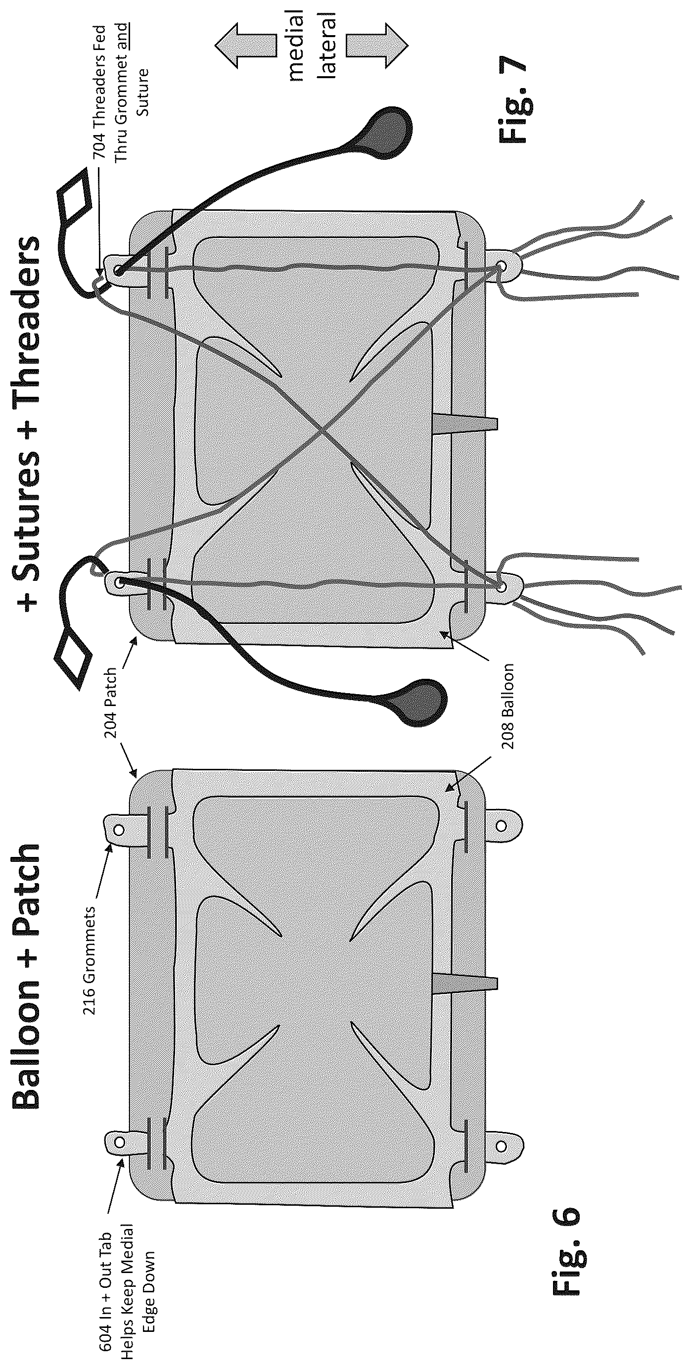 Patent US12324577 Figure 5 – Method of augmenting tissue