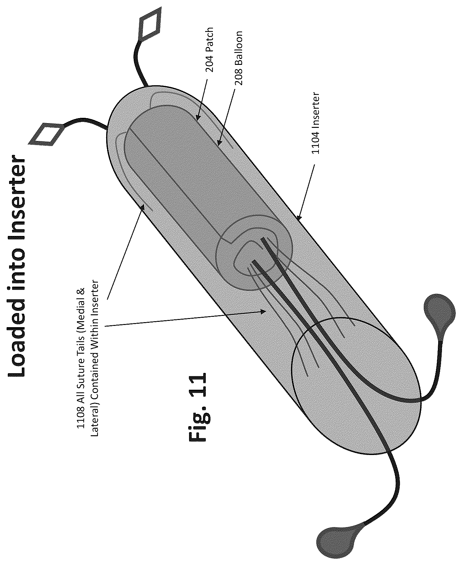 Patent US12324577 Figure 8 – Method of augmenting tissue
