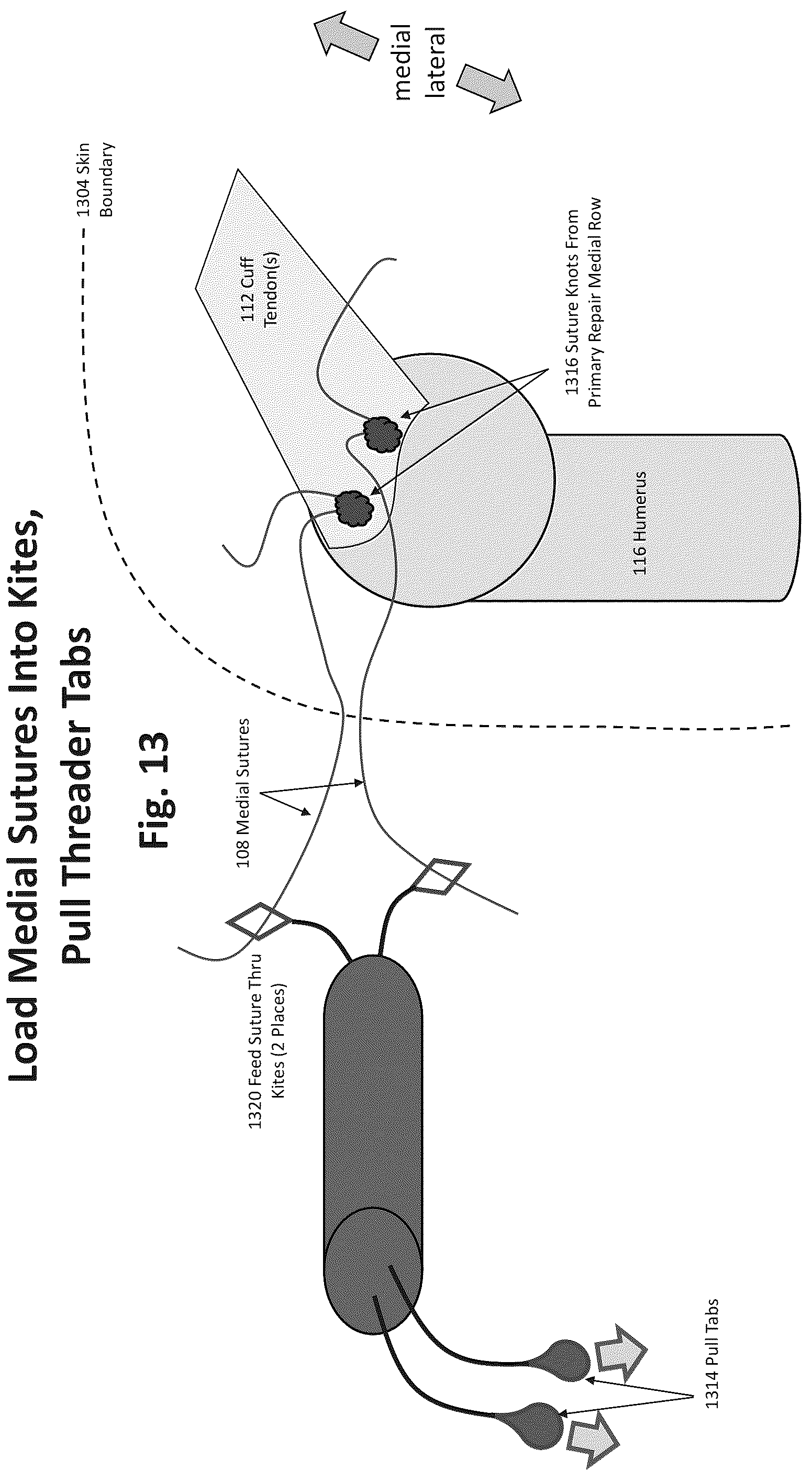 Patent US12324577 Figure 10 – Method of augmenting tissue