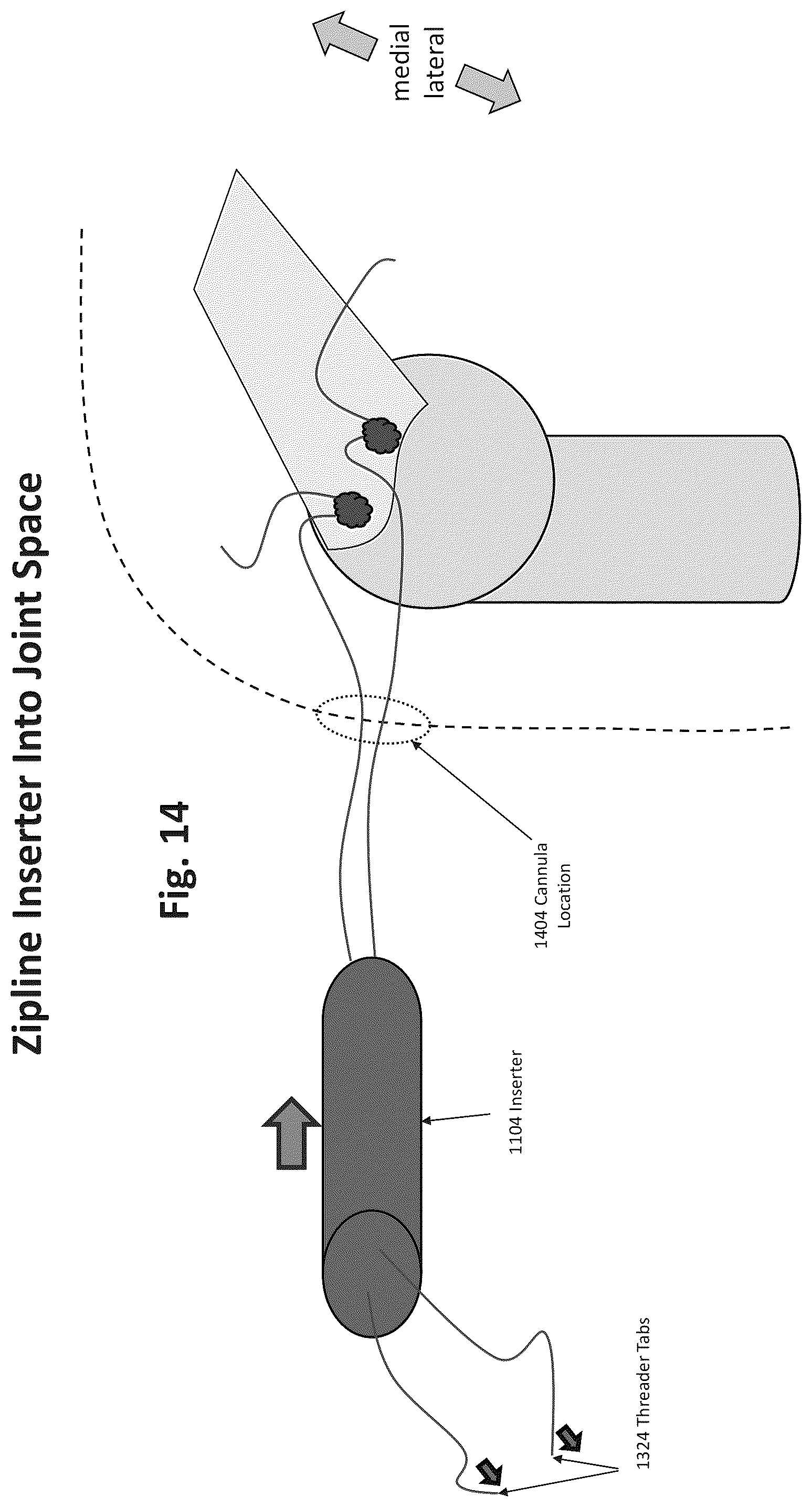 Patent US12324577 Figure 11 – Method of augmenting tissue