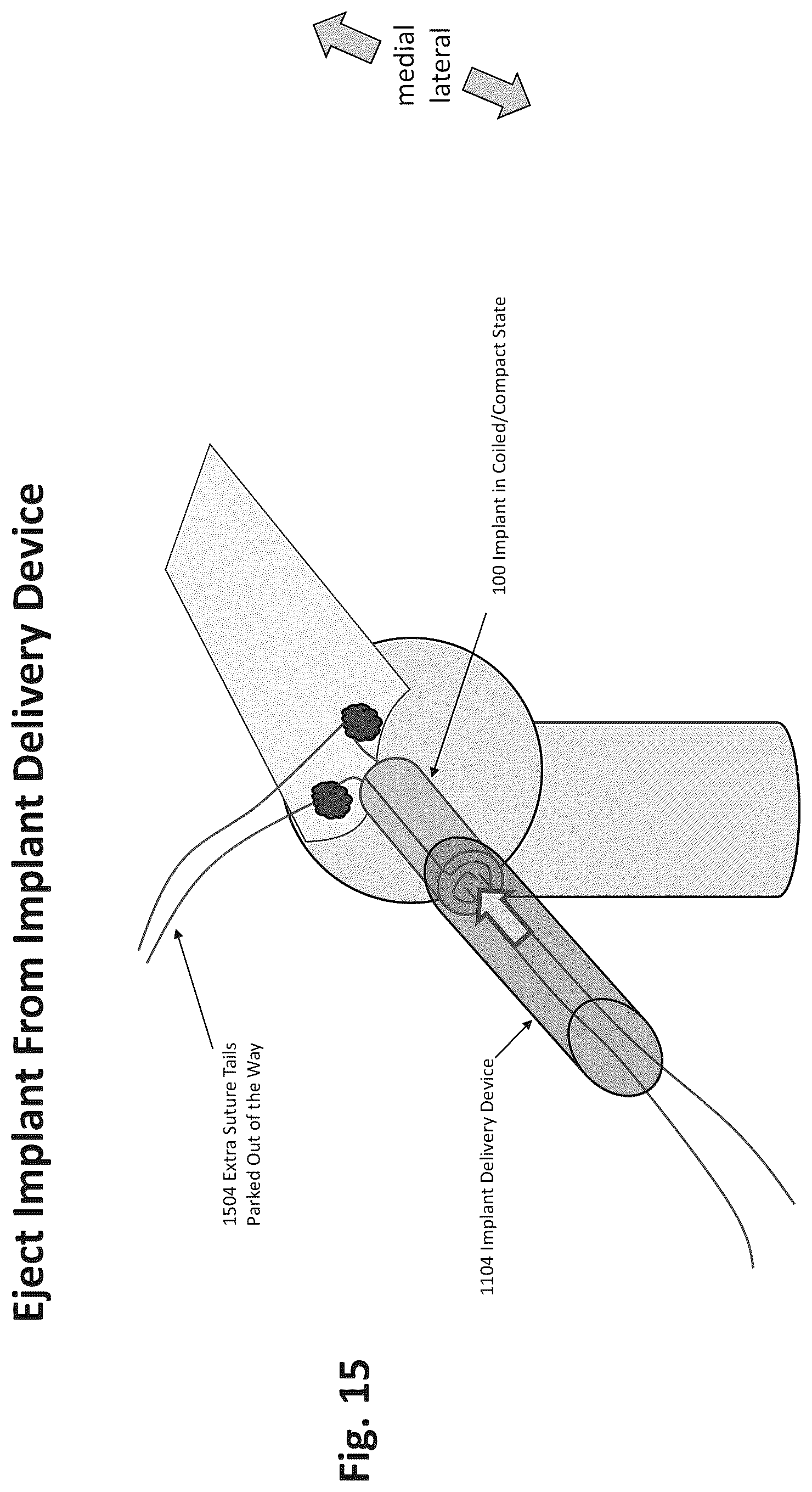 Patent US12324577 Figure 12 – Method of augmenting tissue