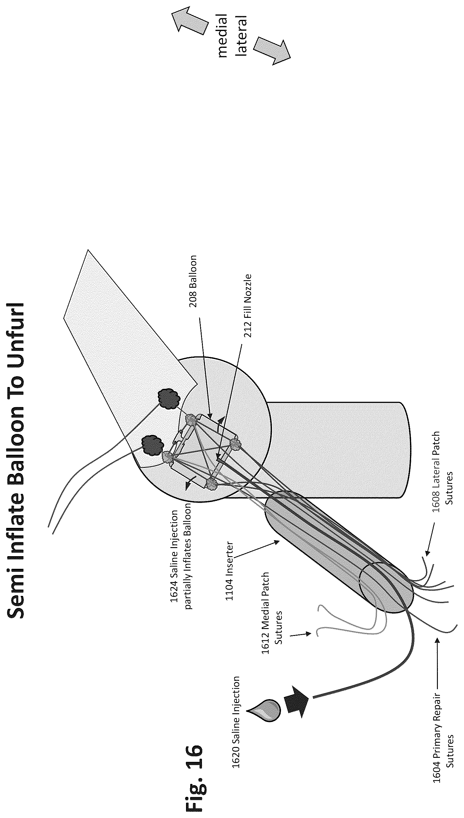 Patent US12324577 Figure 13 – Method of augmenting tissue