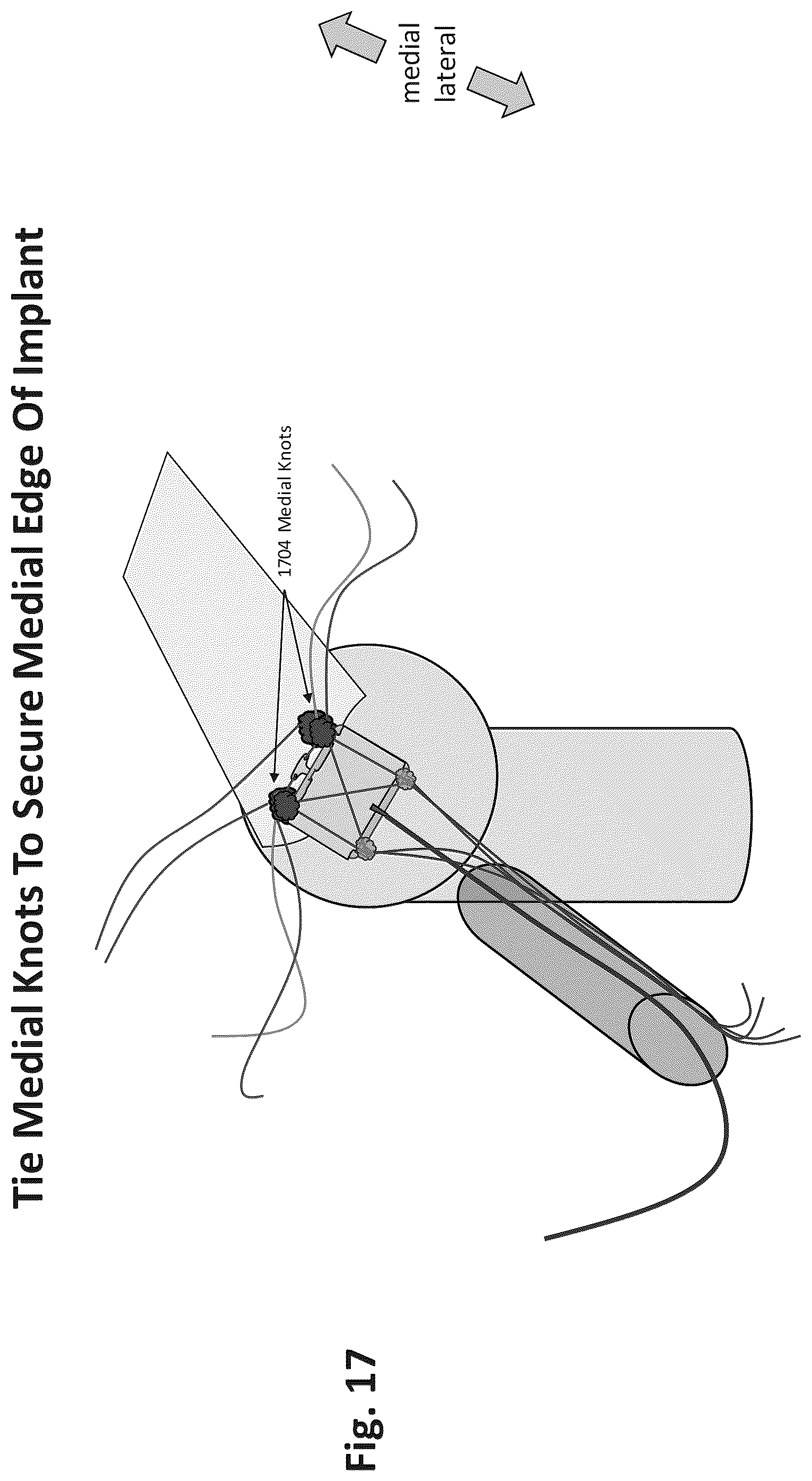 Patent US12324577 Figure 14 – Method of augmenting tissue