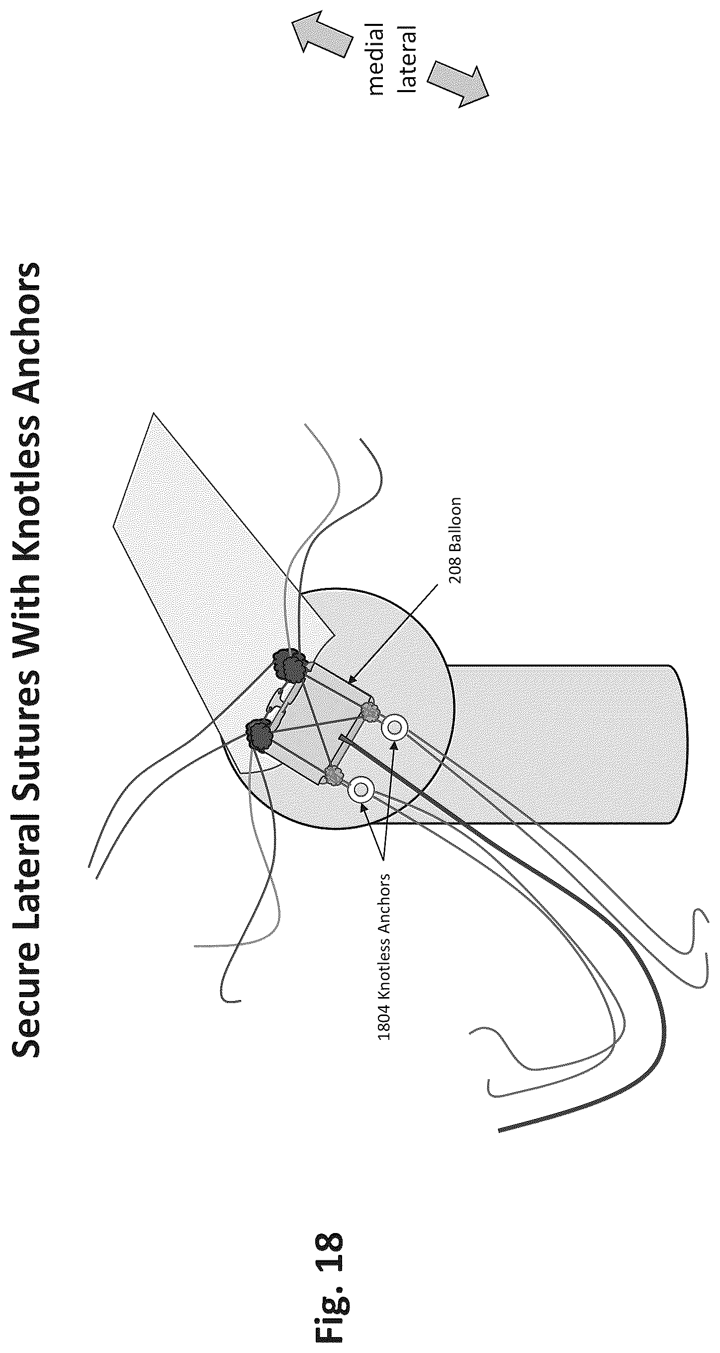 Patent US12324577 Figure 15 – Method of augmenting tissue
