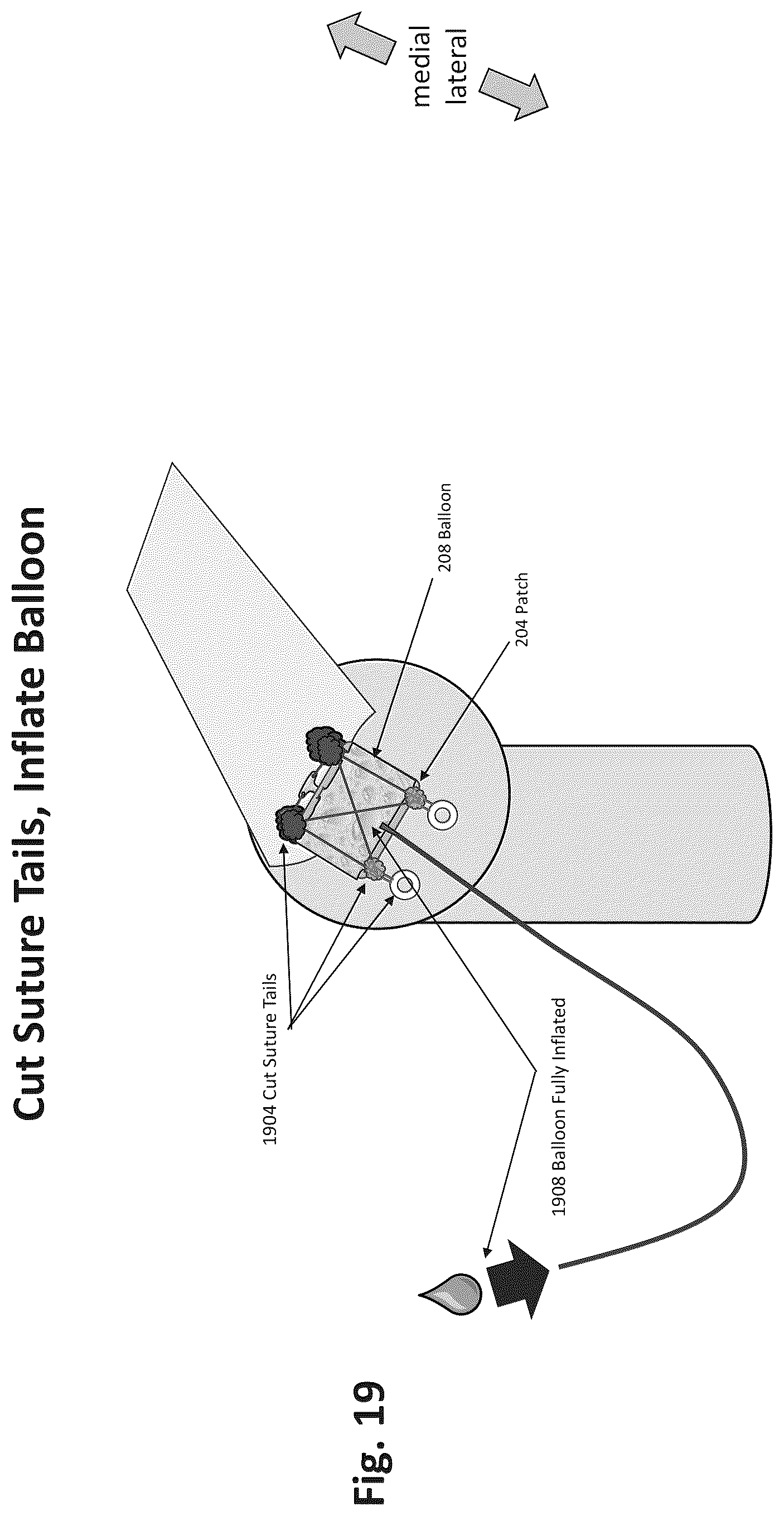 Patent US12324577 Figure 16 – Method of augmenting tissue