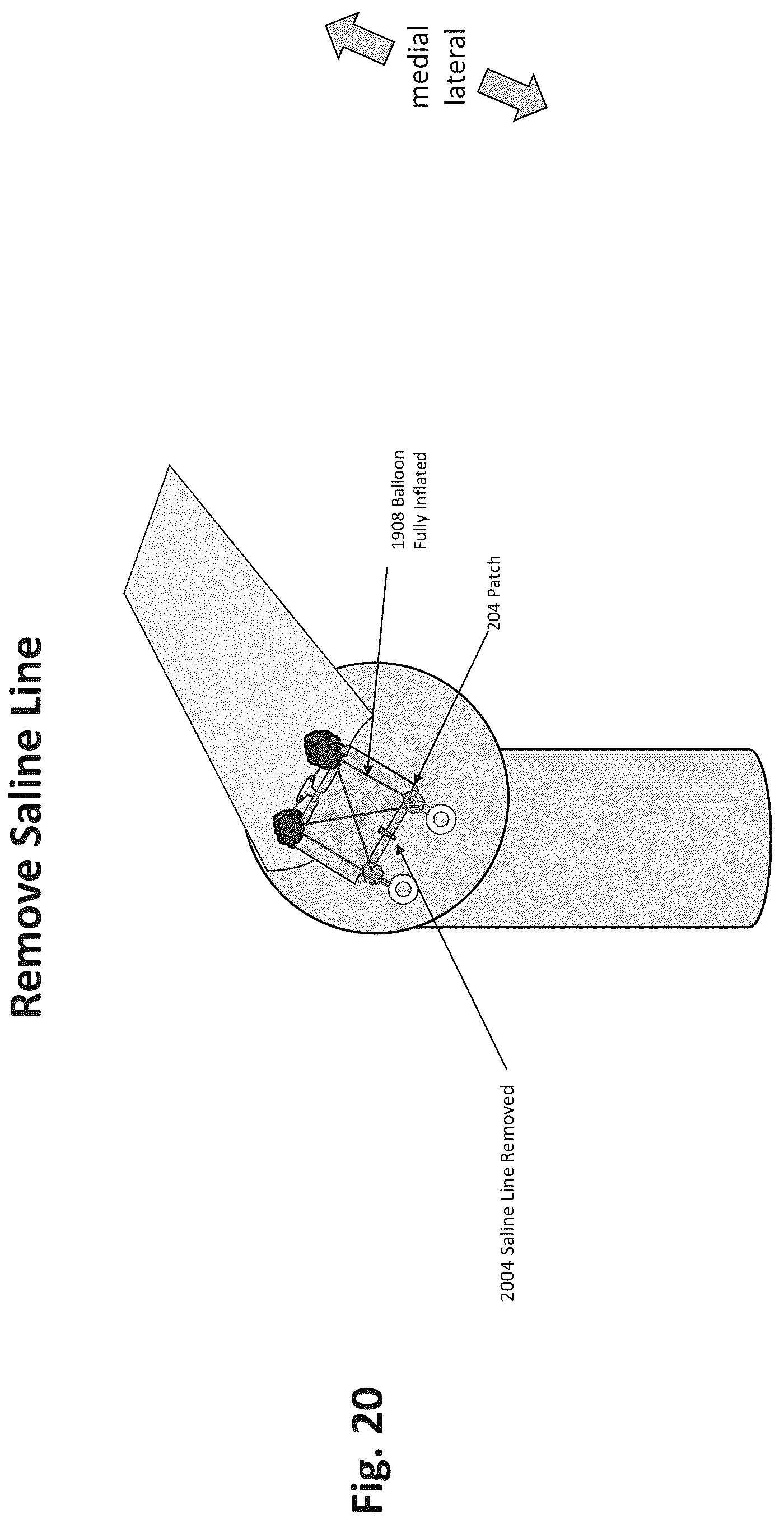 Patent US12324577 Figure 17 – Method of augmenting tissue
