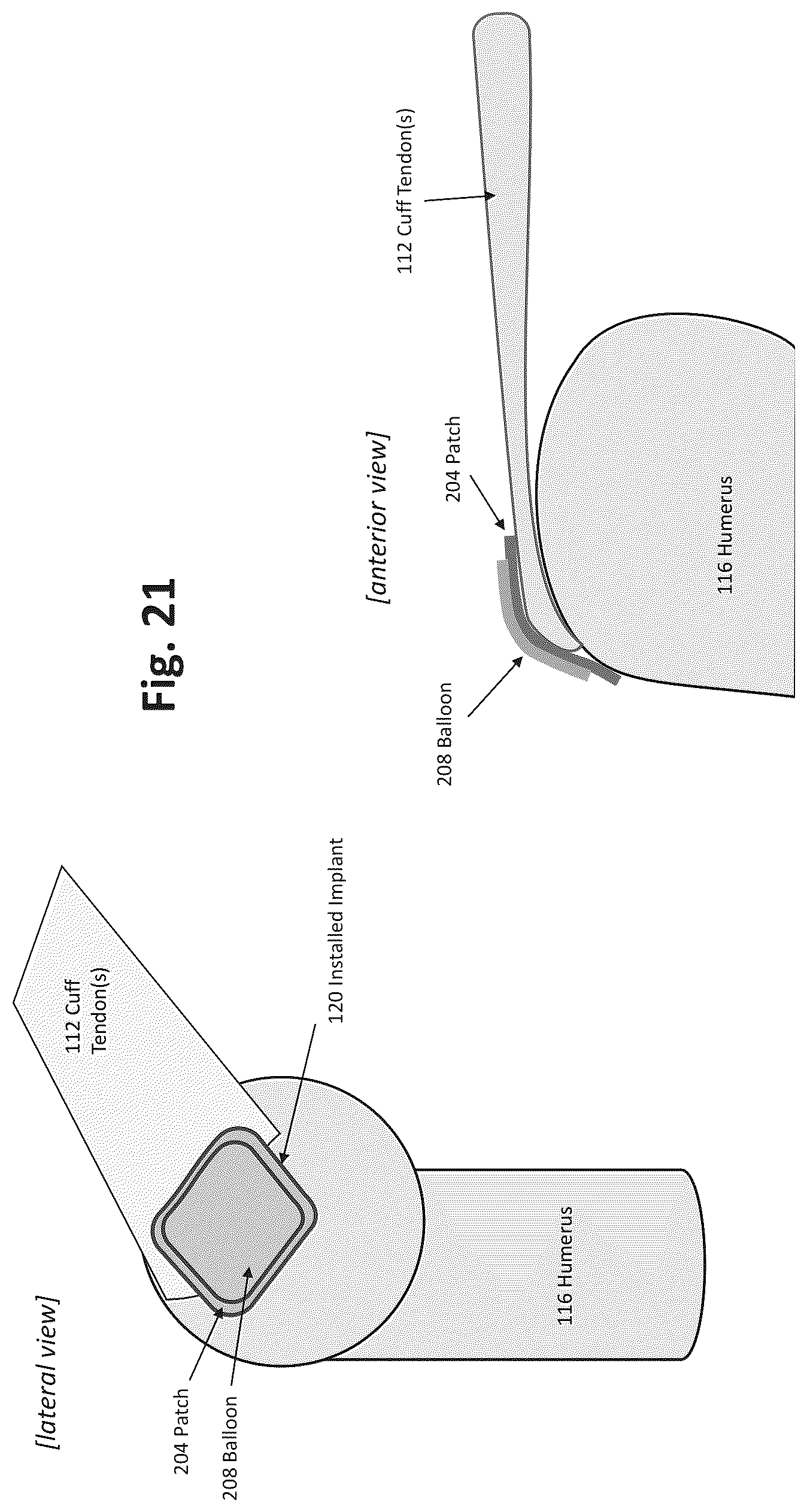 Patent US12324577 Figure 18 – Method of augmenting tissue