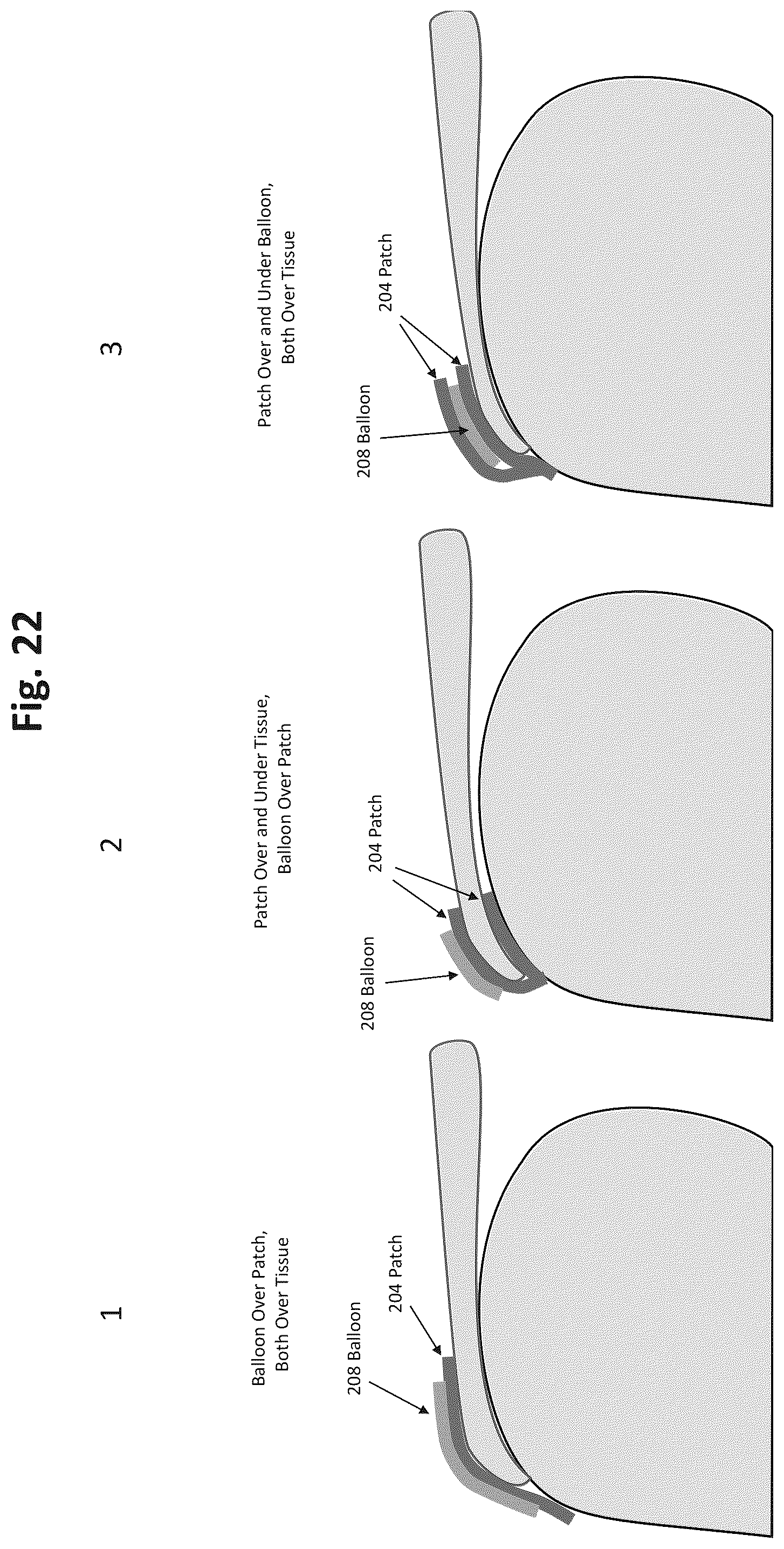 Patent US12324577 Figure 19 – Method of augmenting tissue