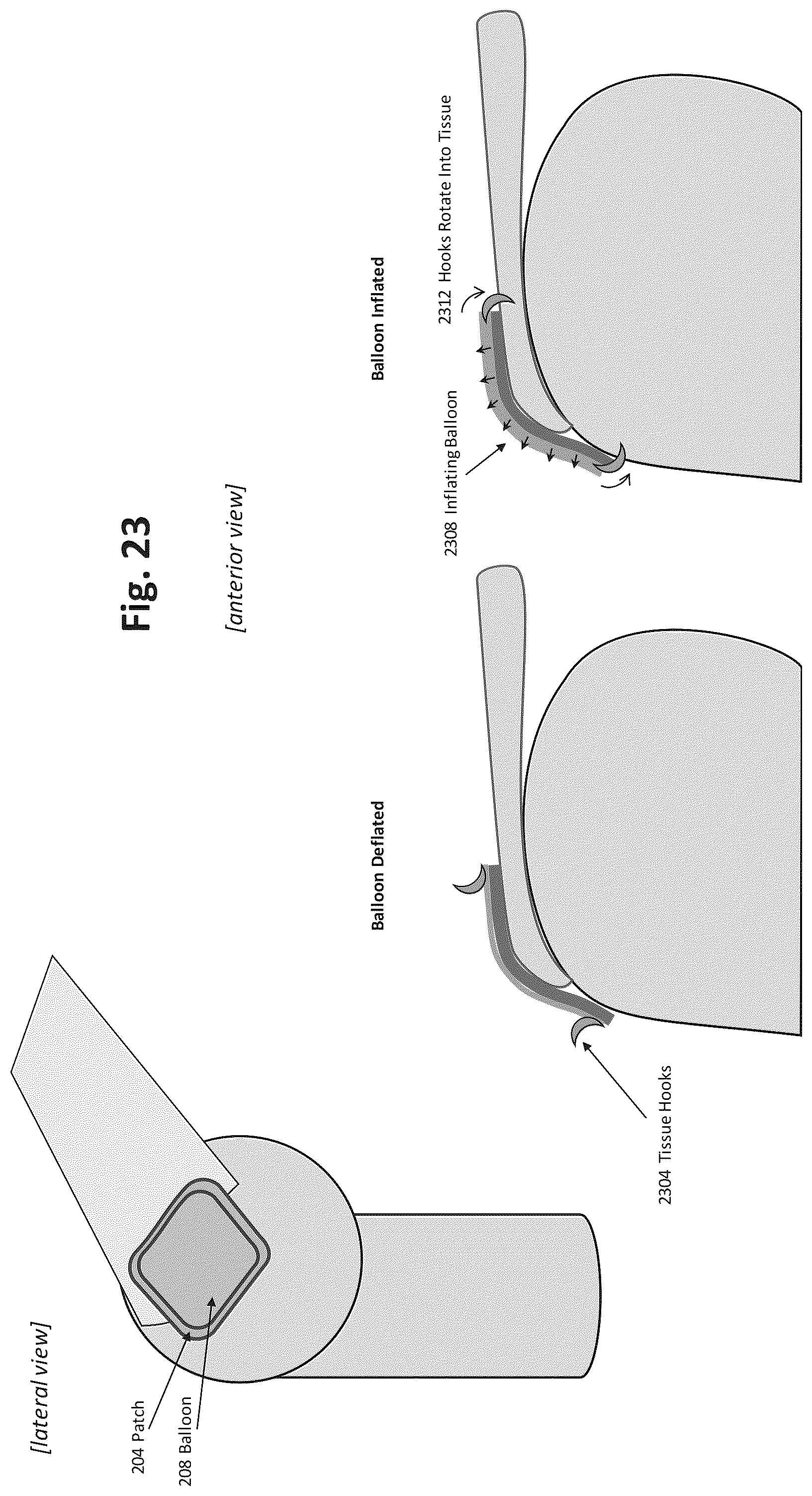 Patent US12324577 Figure 20 – Method of augmenting tissue