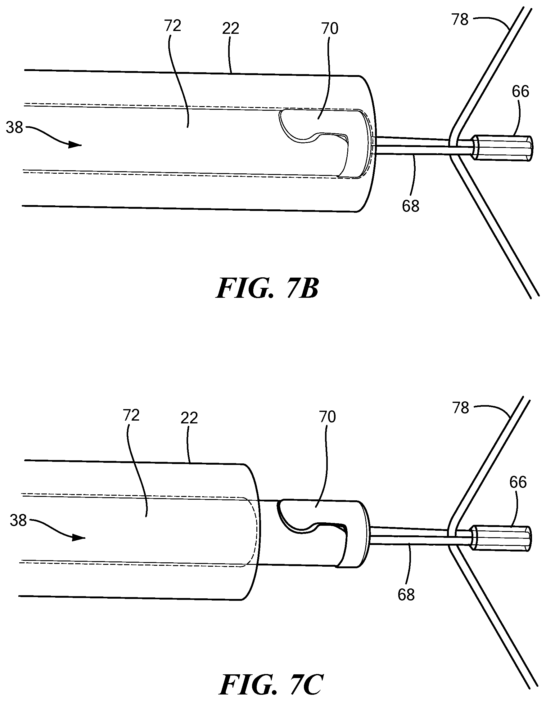 Patent US12324578 Figure 10 – Endoscopic suture cinch