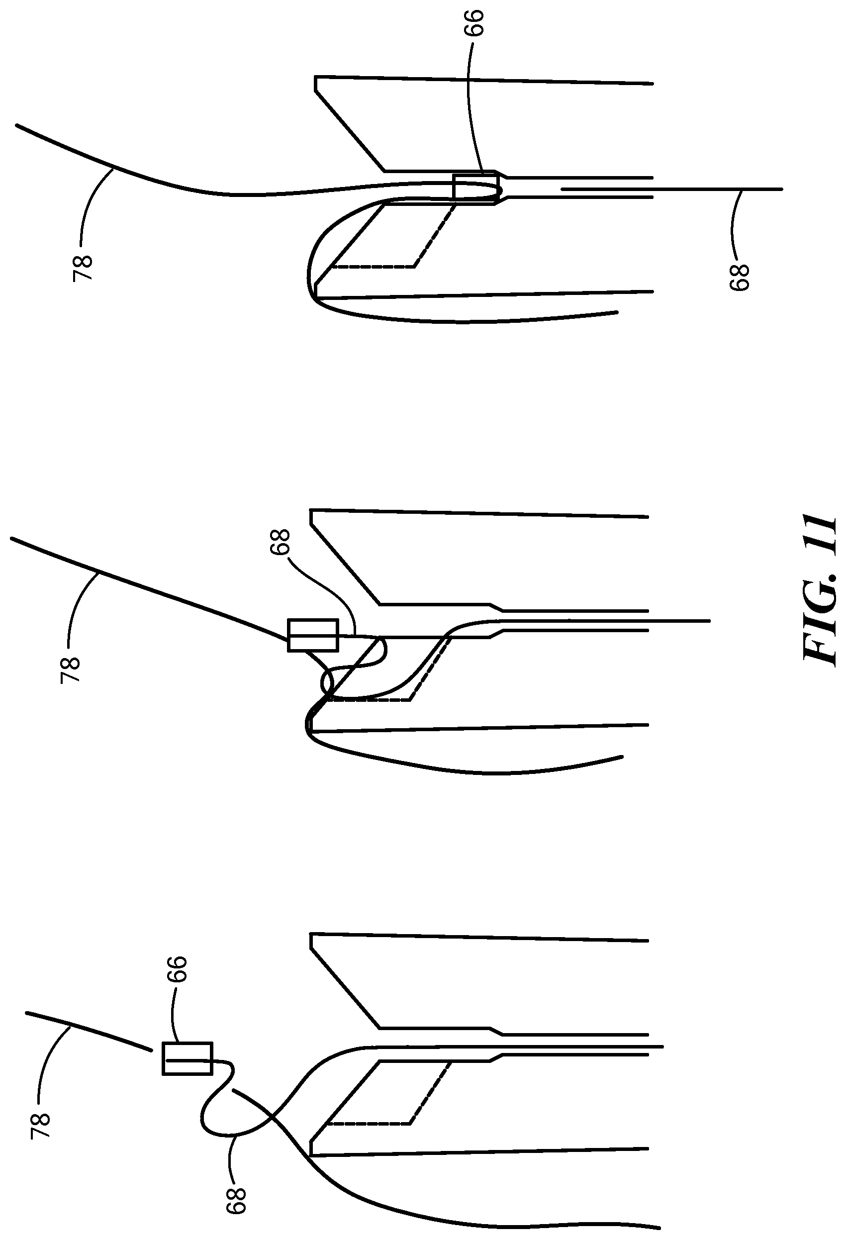 Patent US12324578 Figure 15 – Endoscopic suture cinch