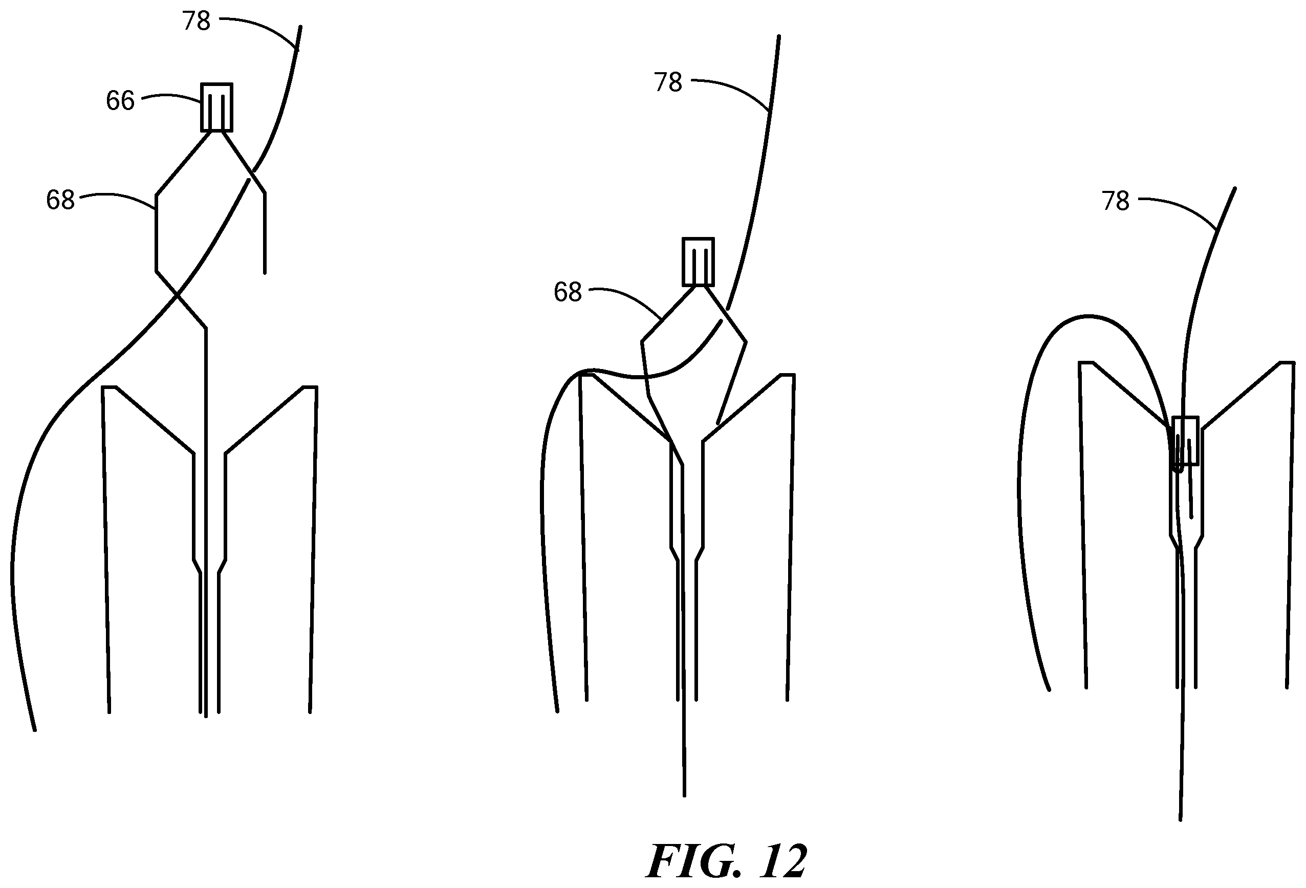 Patent US12324578 Figure 16 – Endoscopic suture cinch