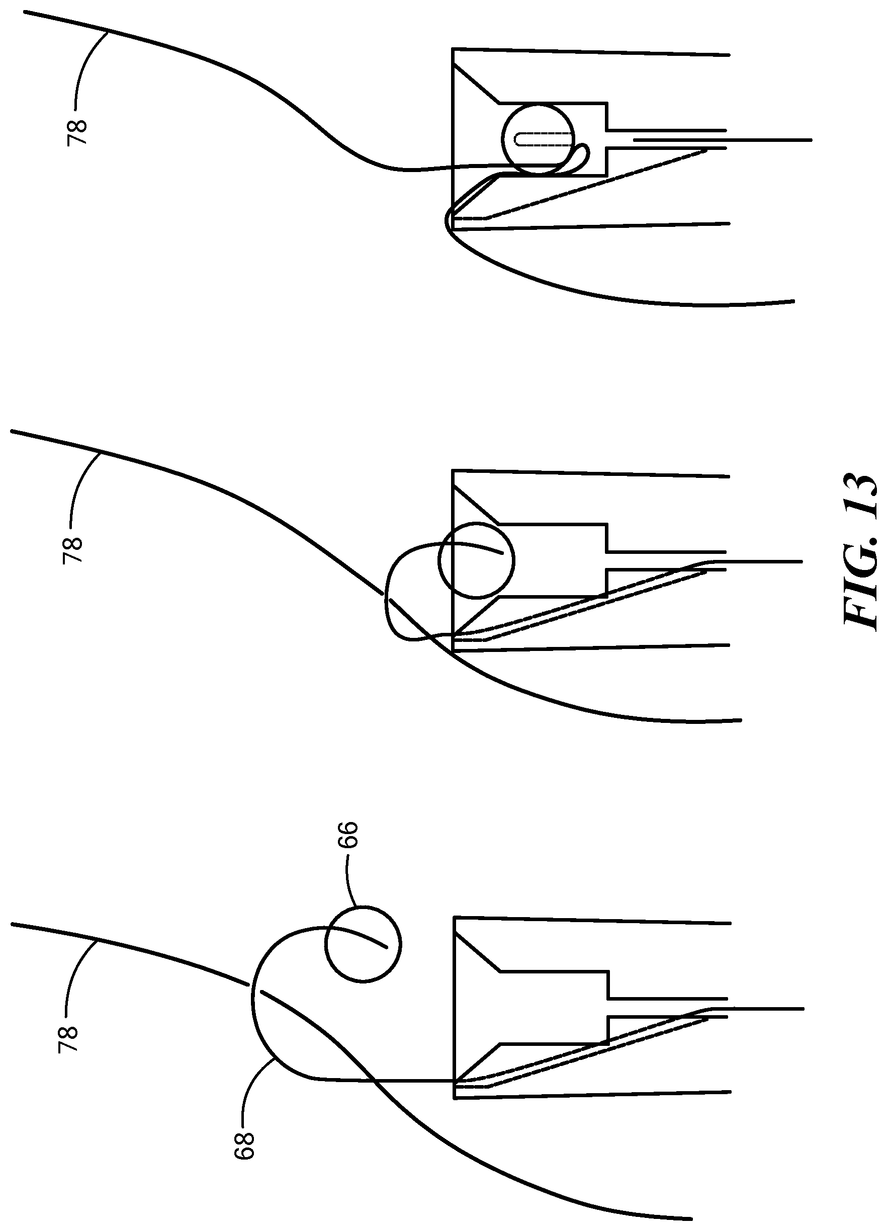 Patent US12324578 Figure 17 – Endoscopic suture cinch