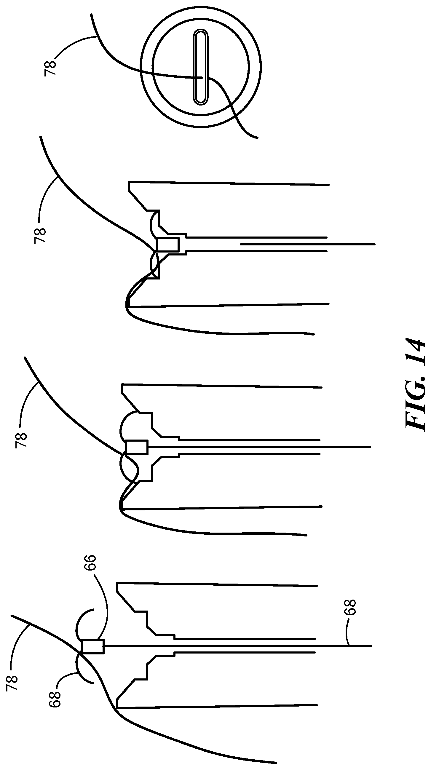 Patent US12324578 Figure 18 – Endoscopic suture cinch