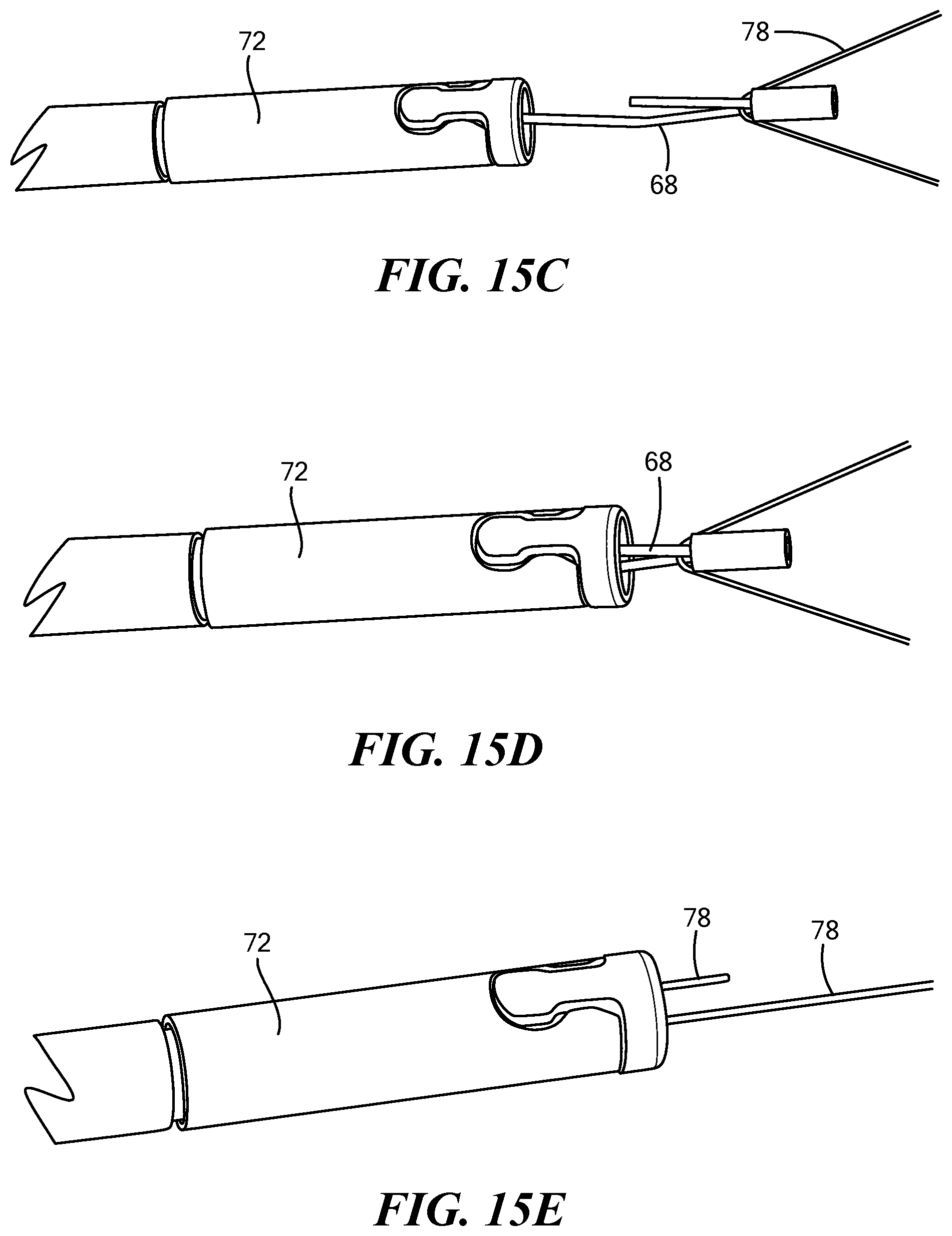 Patent US12324578 Figure 20 – Endoscopic suture cinch