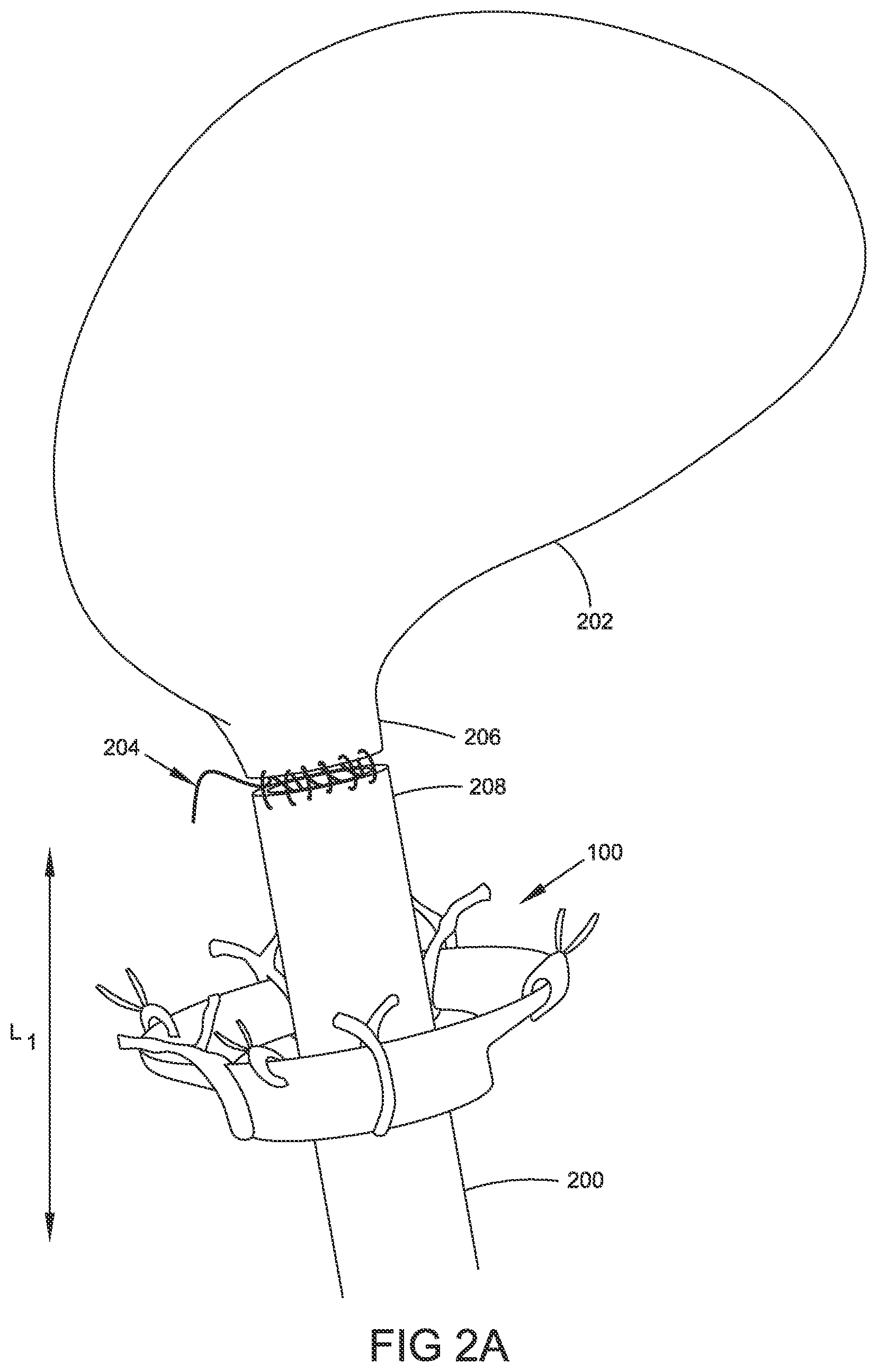 Patent US12324586 Figure 3 – Apparatus and methods for managing a shape of a junction between a bladder and urethra