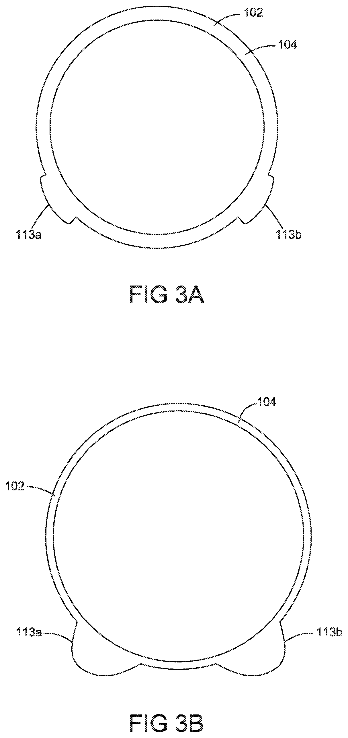 Patent US12324586 Figure 5 – Apparatus and methods for managing a shape of a junction between a bladder and urethra