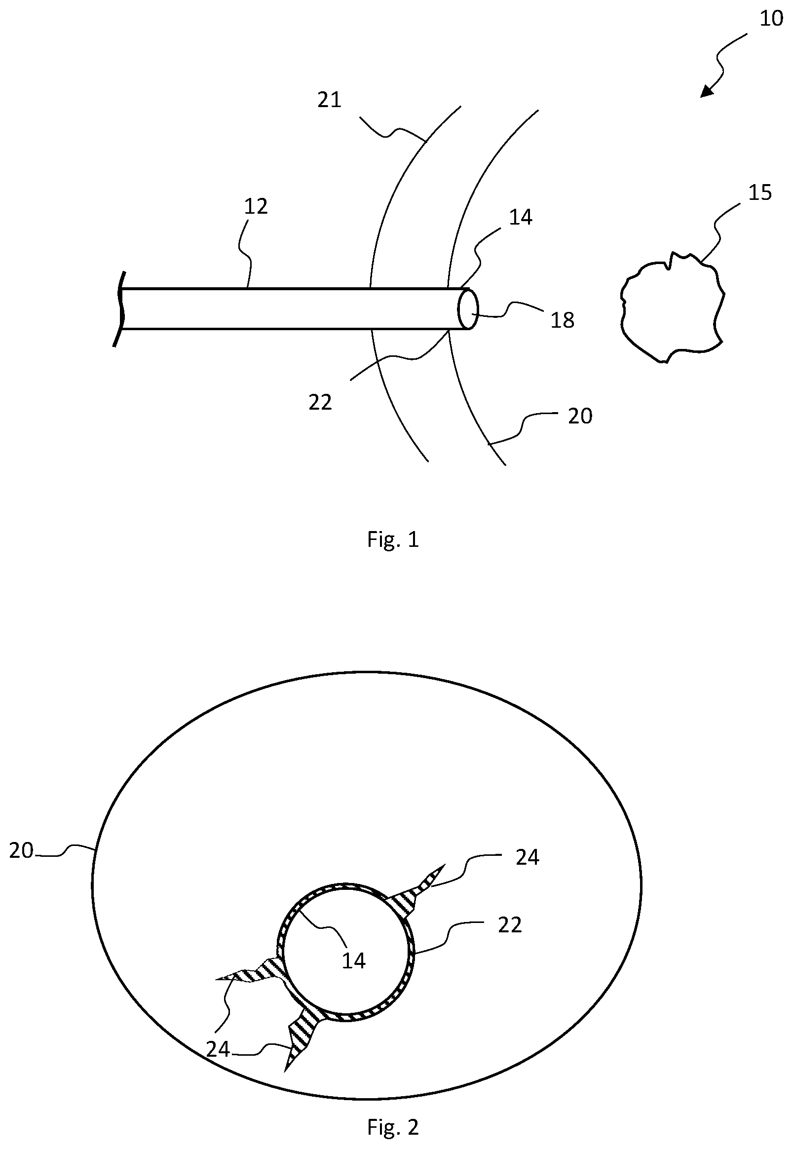 Patent US12324587 Figure 1 – Multistage bioabsorbable plug system