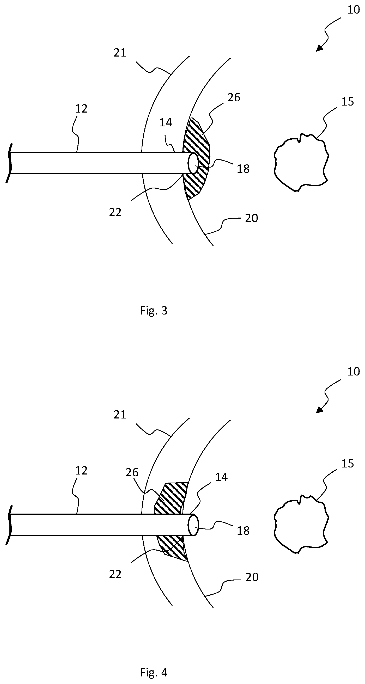 Patent US12324587 Figure 2 – Multistage bioabsorbable plug system