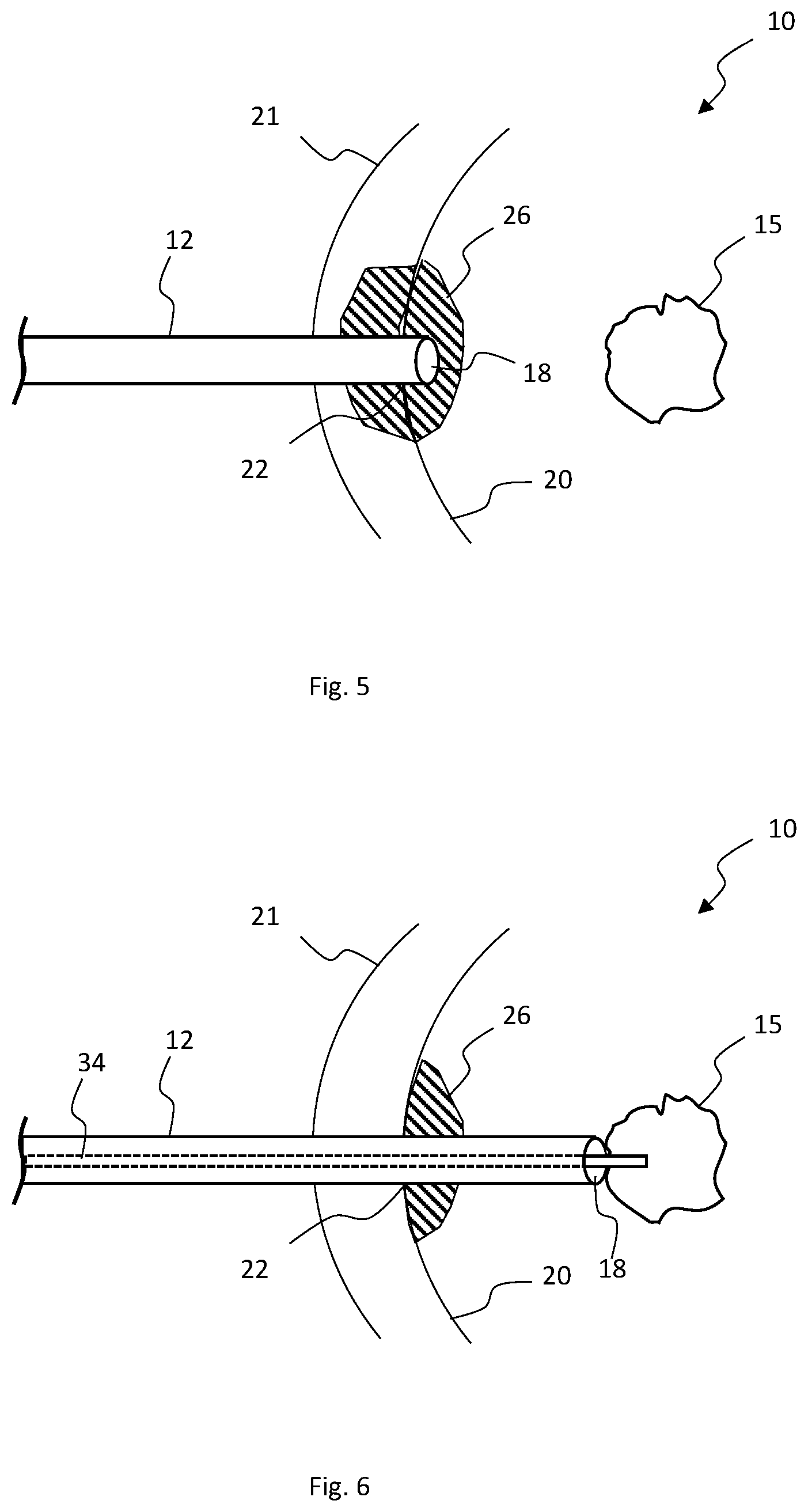 Patent US12324587 Figure 3 – Multistage bioabsorbable plug system