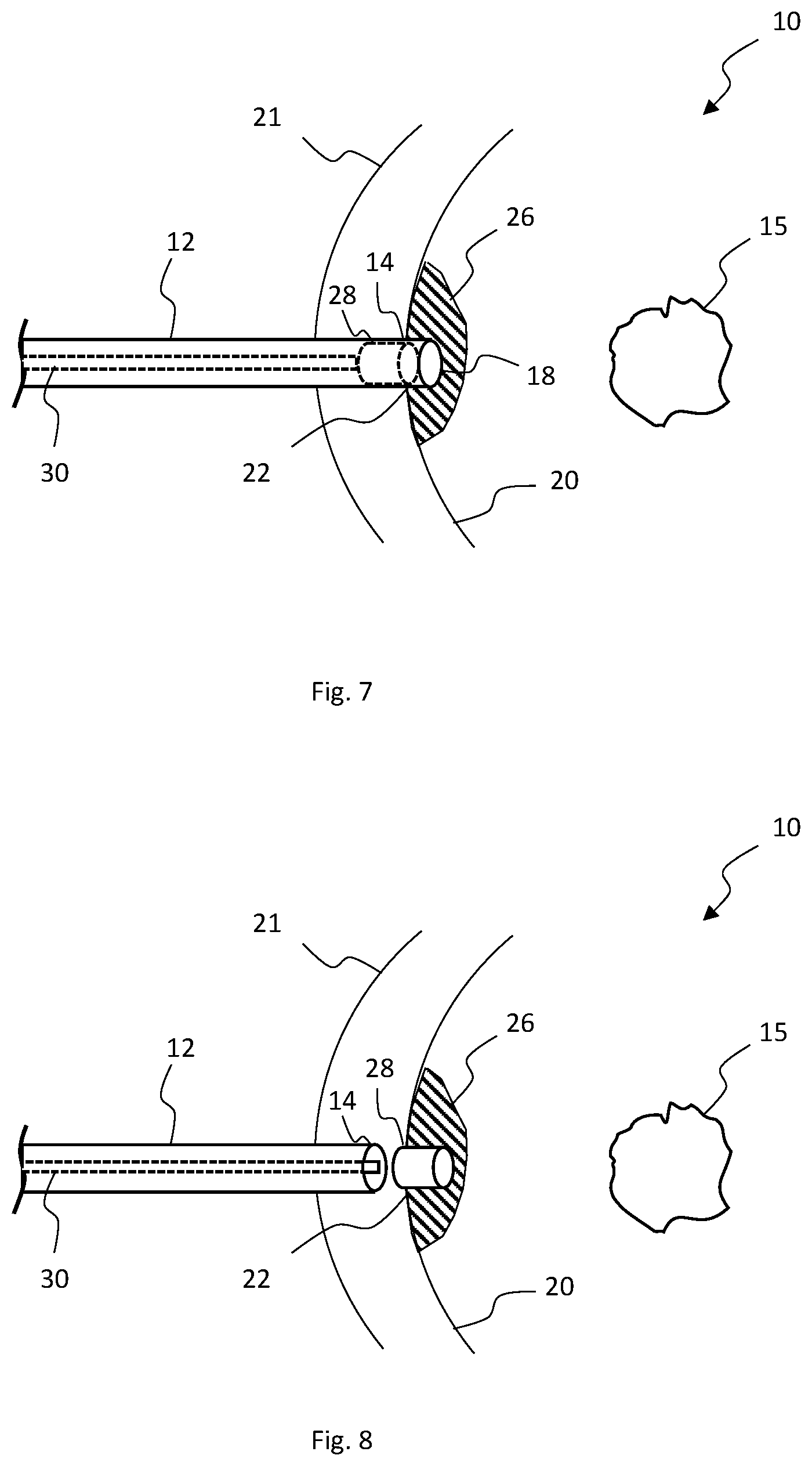Patent US12324587 Figure 4 – Multistage bioabsorbable plug system